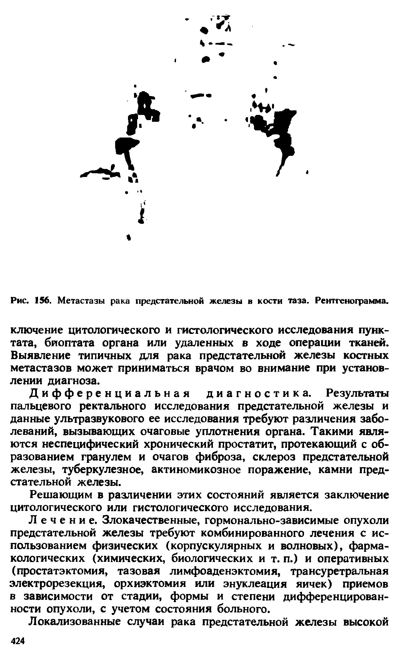 Рис. 156. Метастазы рака предстательной железы в кости таза. Рентгенограмма, ключение цитологического и гистологического исследования пунк-тата, биоптата органа или удаленных в ходе операции тканей. Выявление типичных для рака предстательной железы костных метастазов может приниматься врачом во внимание при установлении диагноза.