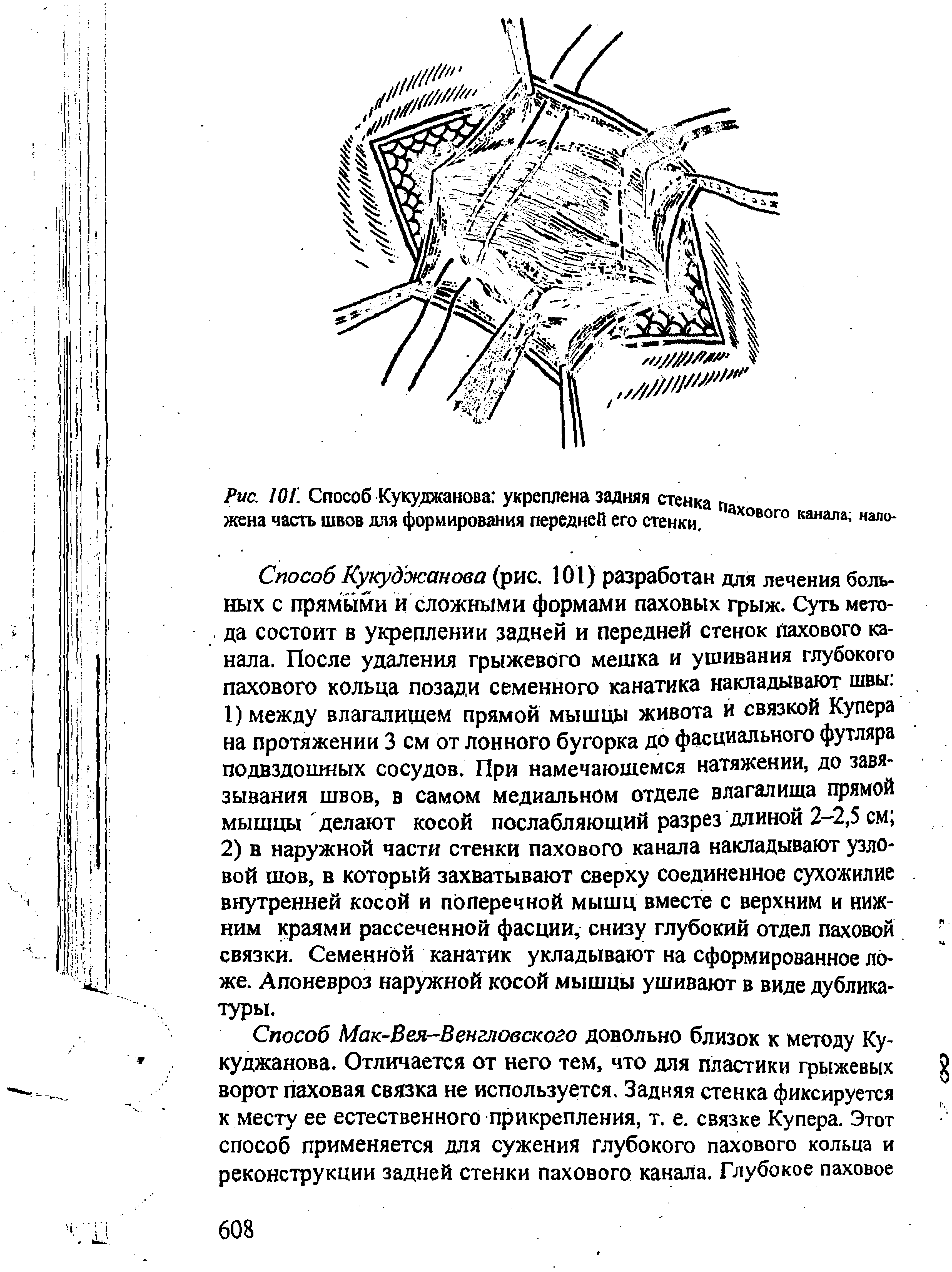 Рис. ЮГ. Способ Кукуджанова укреплена задняя стенка и жена часть швов для формирования передней его стенки. Хового канала нало-...