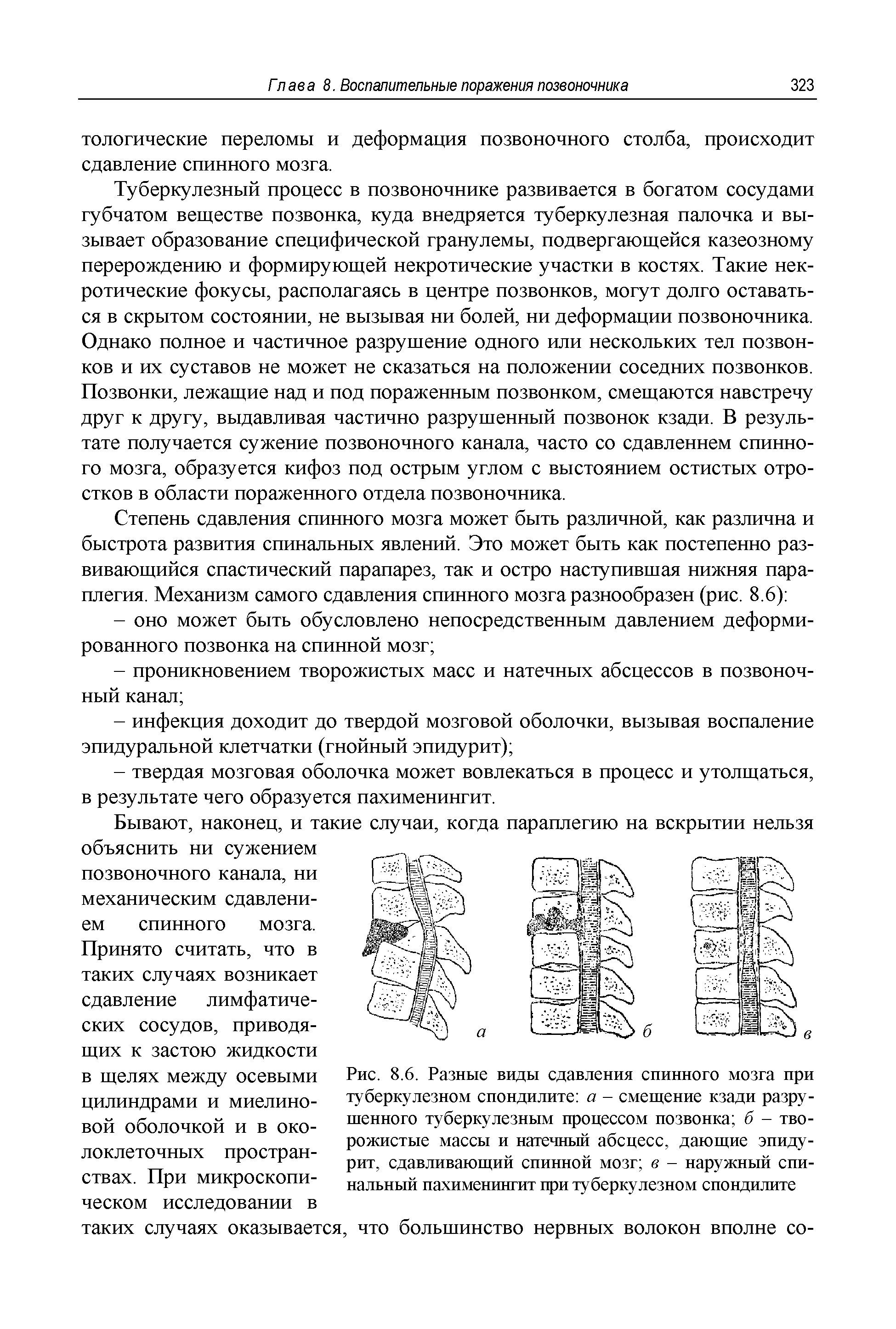 Рис. 8.6. Разные виды сдавления спинного мозга при туберкулезном спондилите а - смещение кзади разрушенного туберкулезным процессом позвонка б - творожистые массы и натечный абсцесс, дающие эпидурит, сдавливающий спинной мозг в - наружный спинальный пахименингит при туберкулезном спондилите...