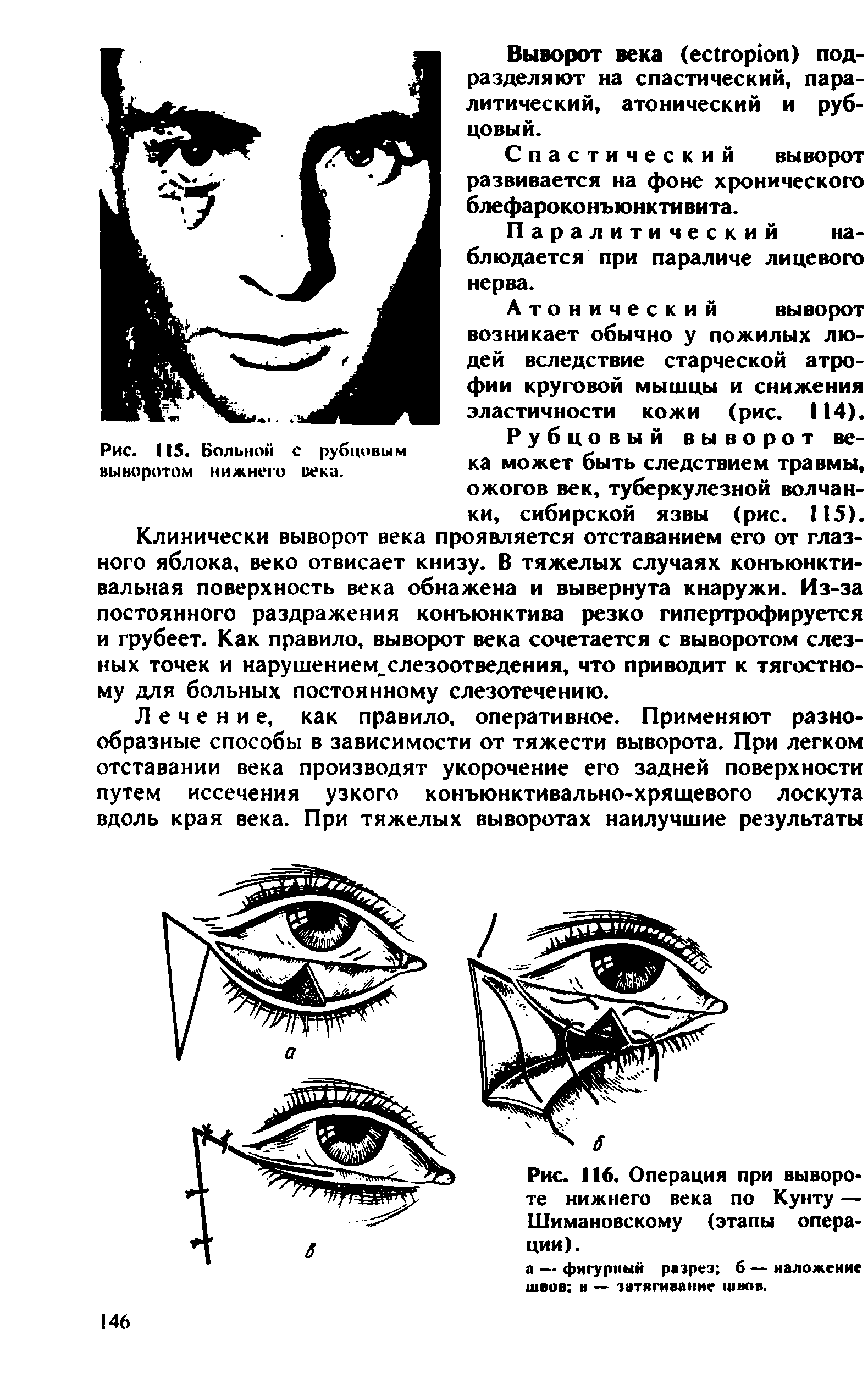 Рис. 116. Операция при вывороте нижнего века по Кунту — Шимановскому (этапы операции).