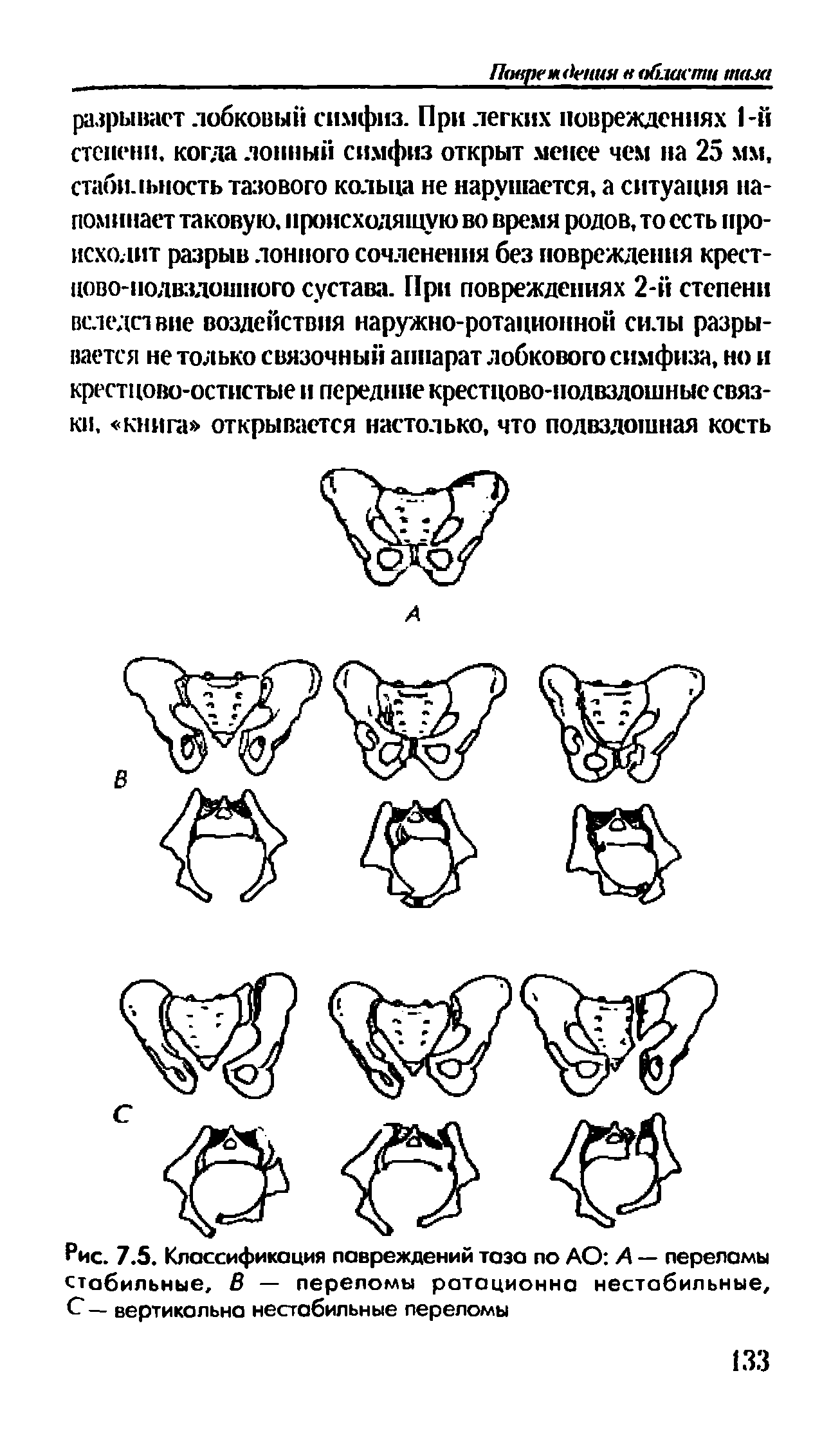 Рис. 7.5. Классификация повреждений таза по АО А — переломы стабильные, В — переломы ратационна нестабильные, С — вертикальна нестабильные переломы...