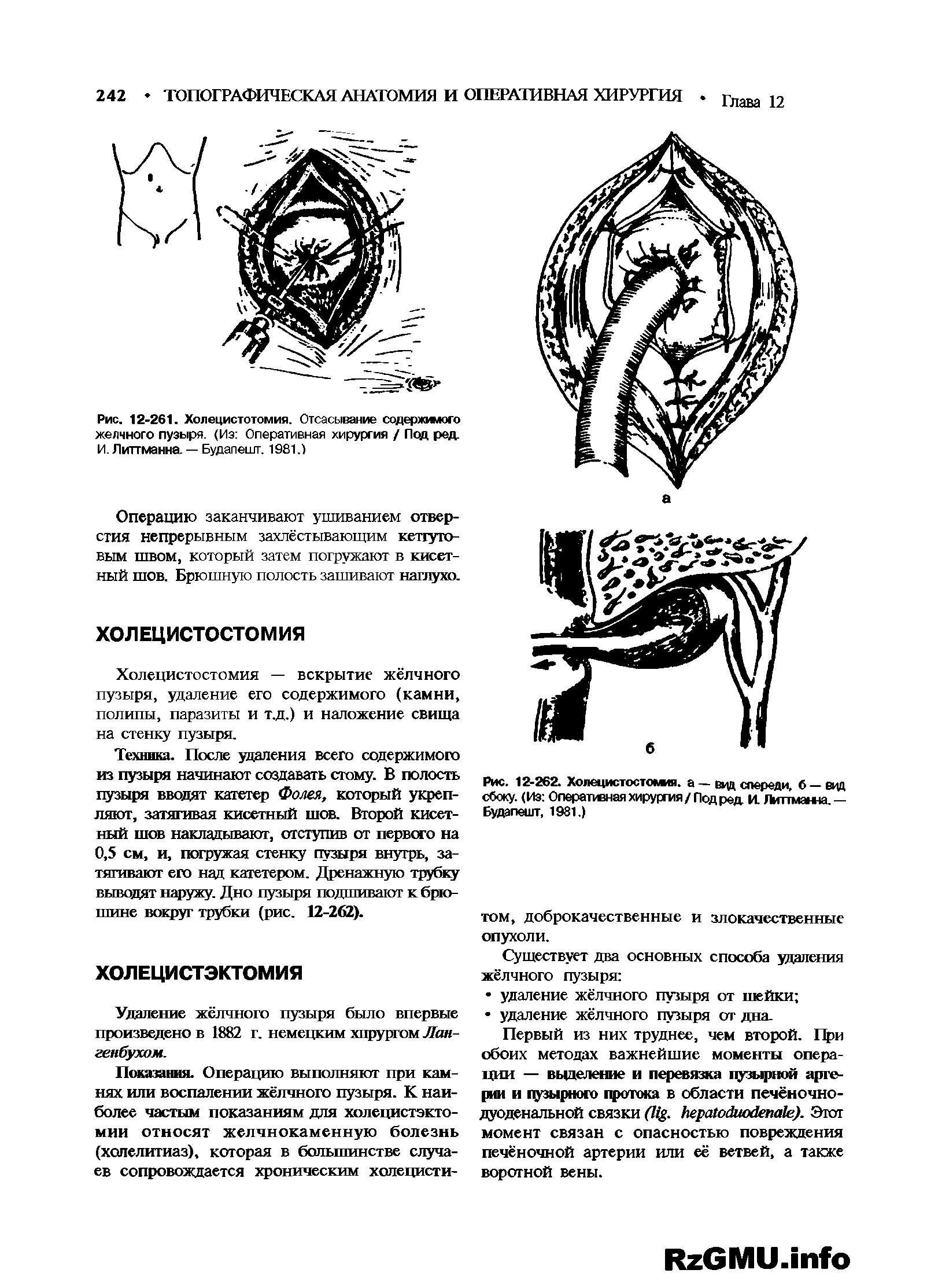Рис. 12-261. Холецистотомия. Отсасывание содержимого желчного пузыря. (Из Оперативная хирургия / Под род. И.Литтманна.— Будапешт. 1981.)...