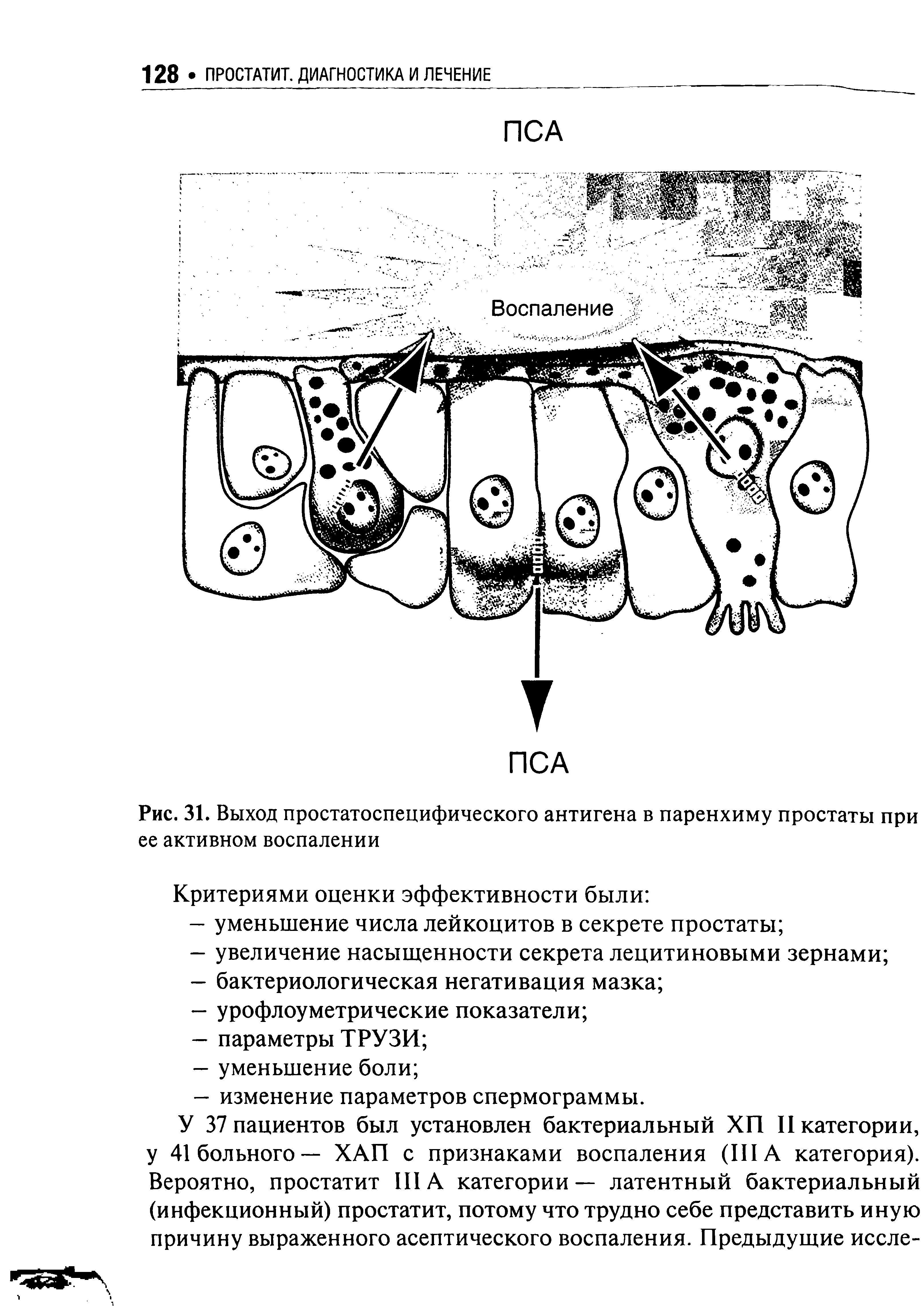 Рис. 31. Выход простатоспецифического антигена в паренхиму простаты при ее активном воспалении...