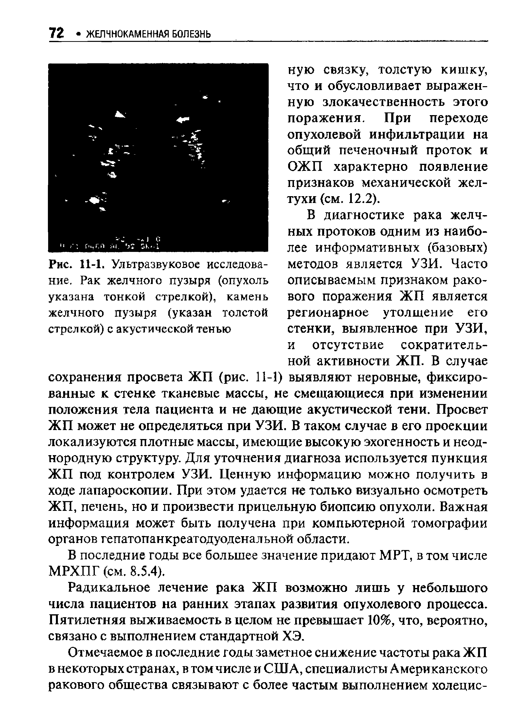 Рис. 11-1. Ультразвуковое исследование. Рак желчного пузыря (опухоль указана тонкой стрелкой), камень желчного пузыря (указан толстой стрелкой) с акустической тенью...