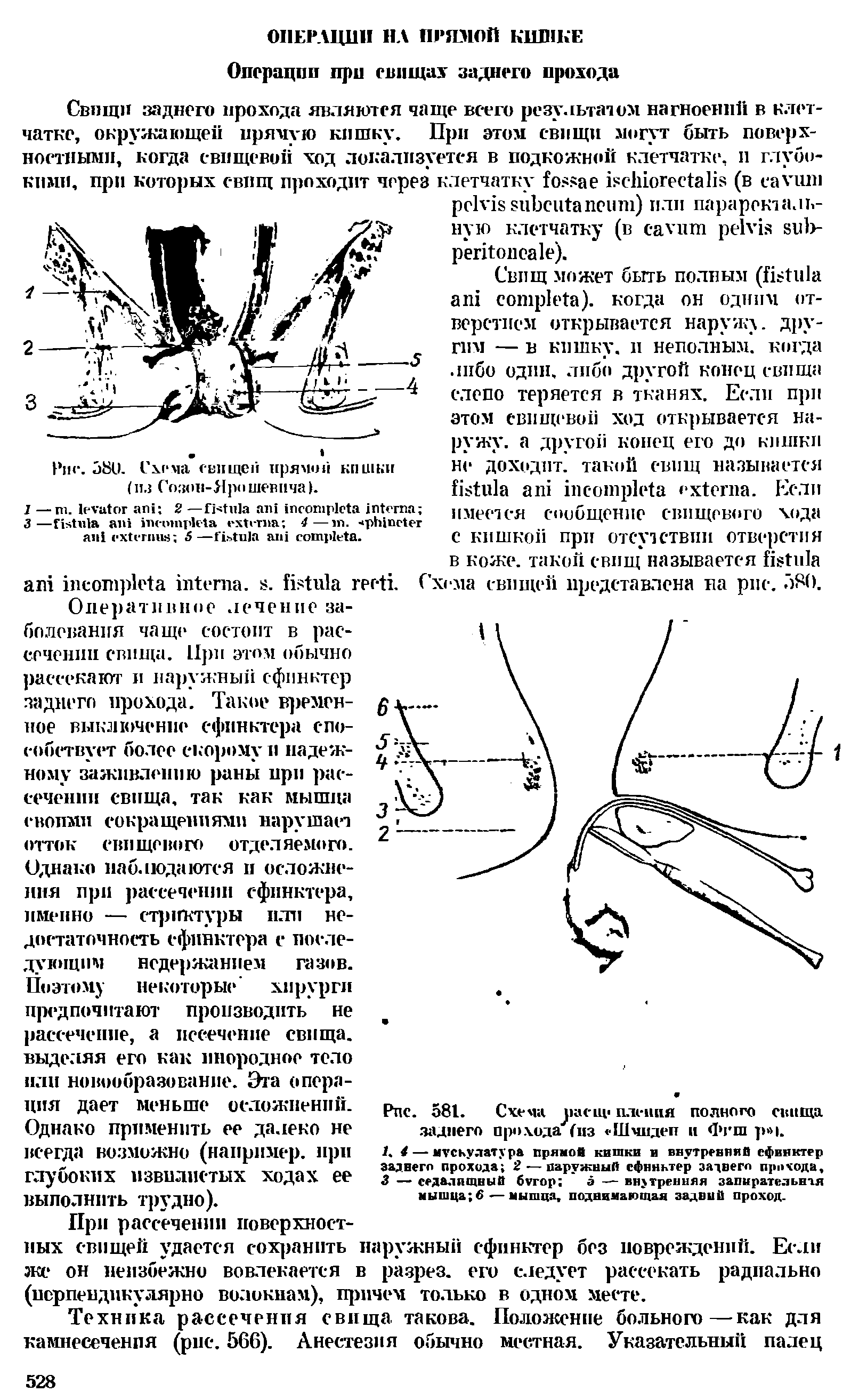 Рис. 380. Схема свищей прямой кишки (из Созон-Яро шевпча).