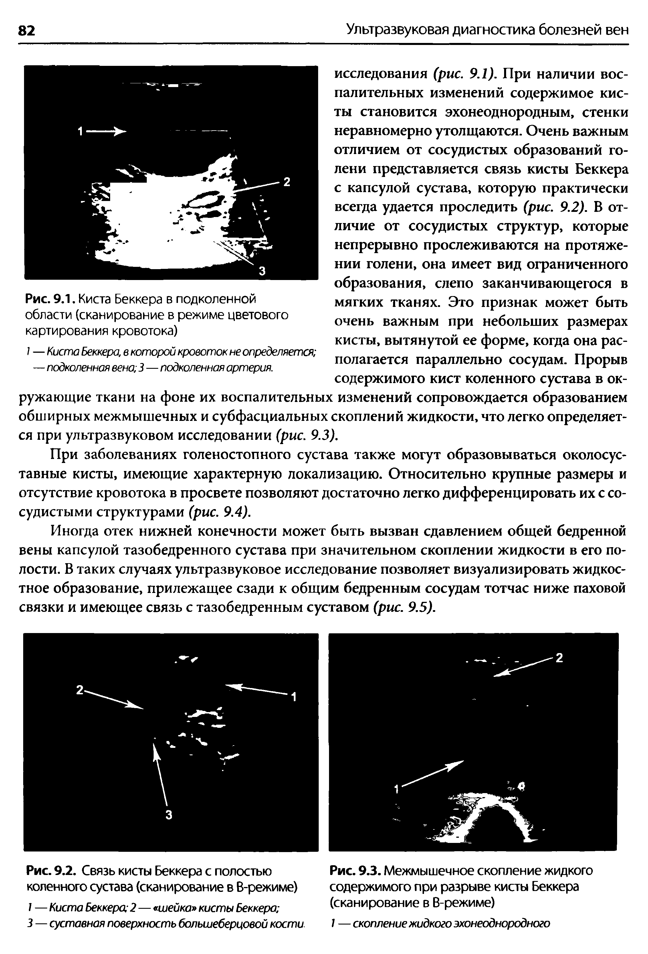 Рис. 9.2. Связь кисты Беккера с полостью коленного сустава (сканирование в В-режиме)...