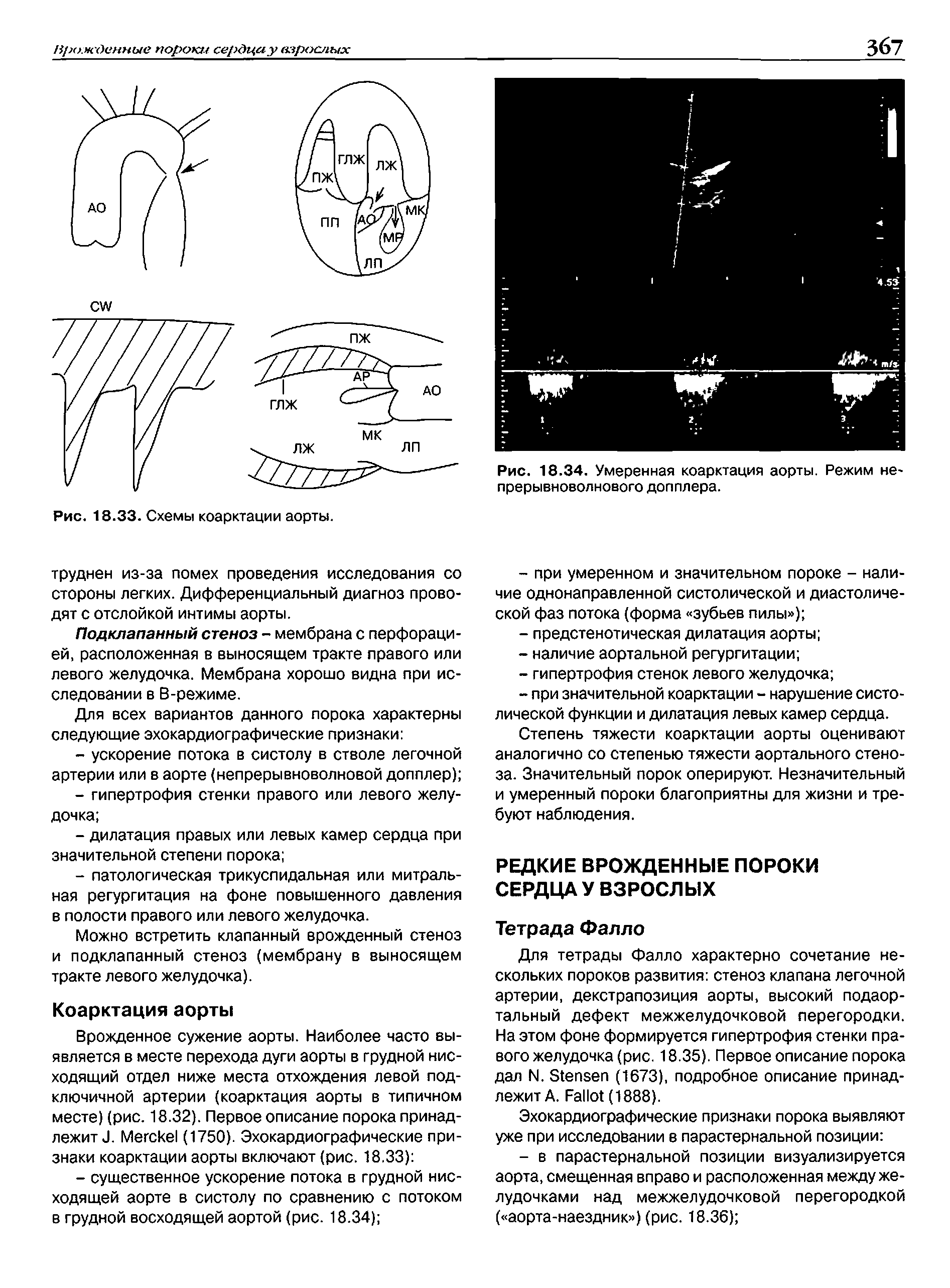 Рис. 18.34. Умеренная коарктация аорты. Режим непрерывноволнового допплера.