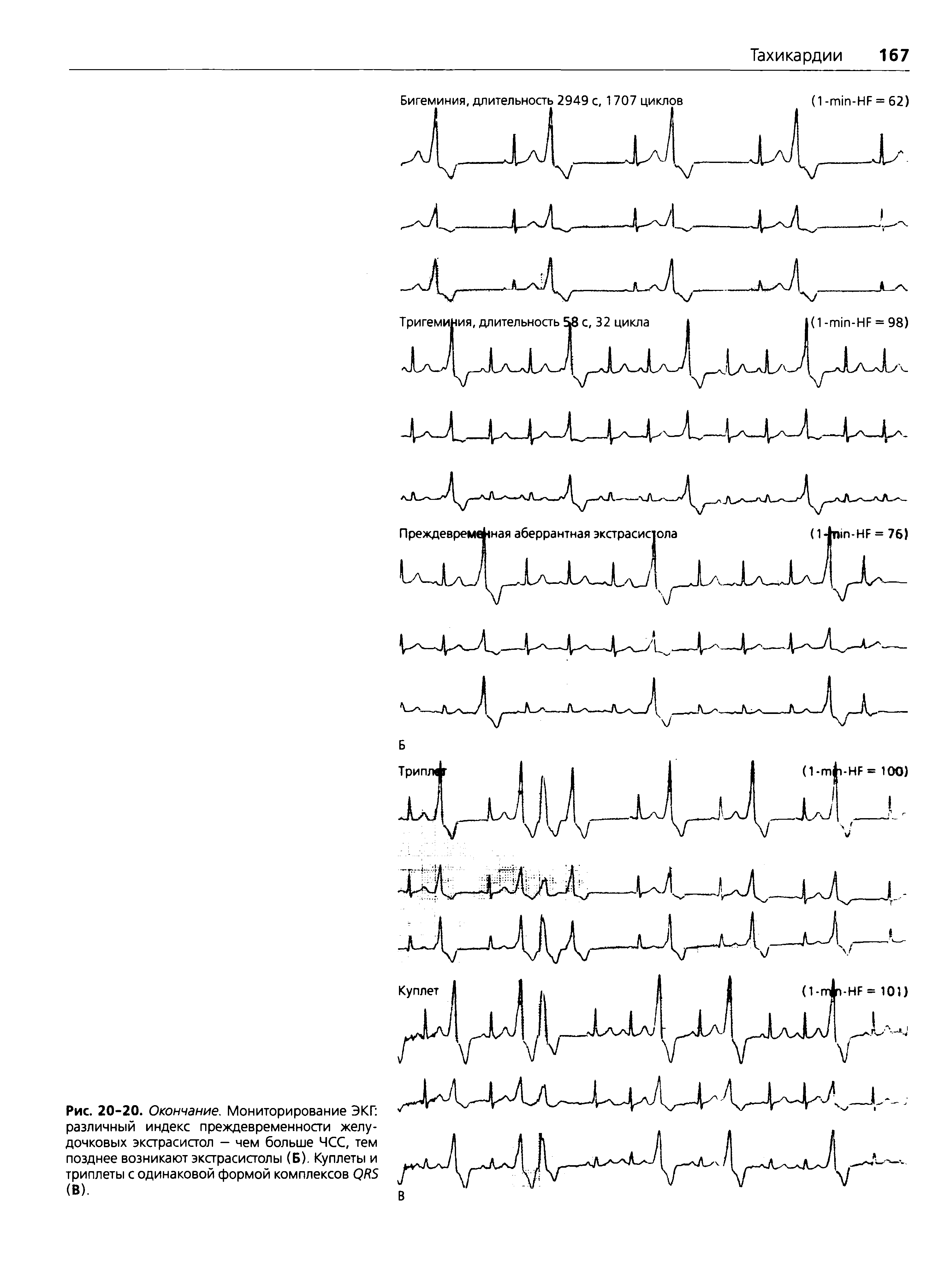 Рис. 20-20. Окончание. Мониторирование ЭКГ различный индекс преждевременности желудочковых экстрасистол — чем больше ЧСС, тем позднее возникают экстрасистолы (Б). Куплеты и триплеты с одинаковой формой комплексов ОИБ (В).