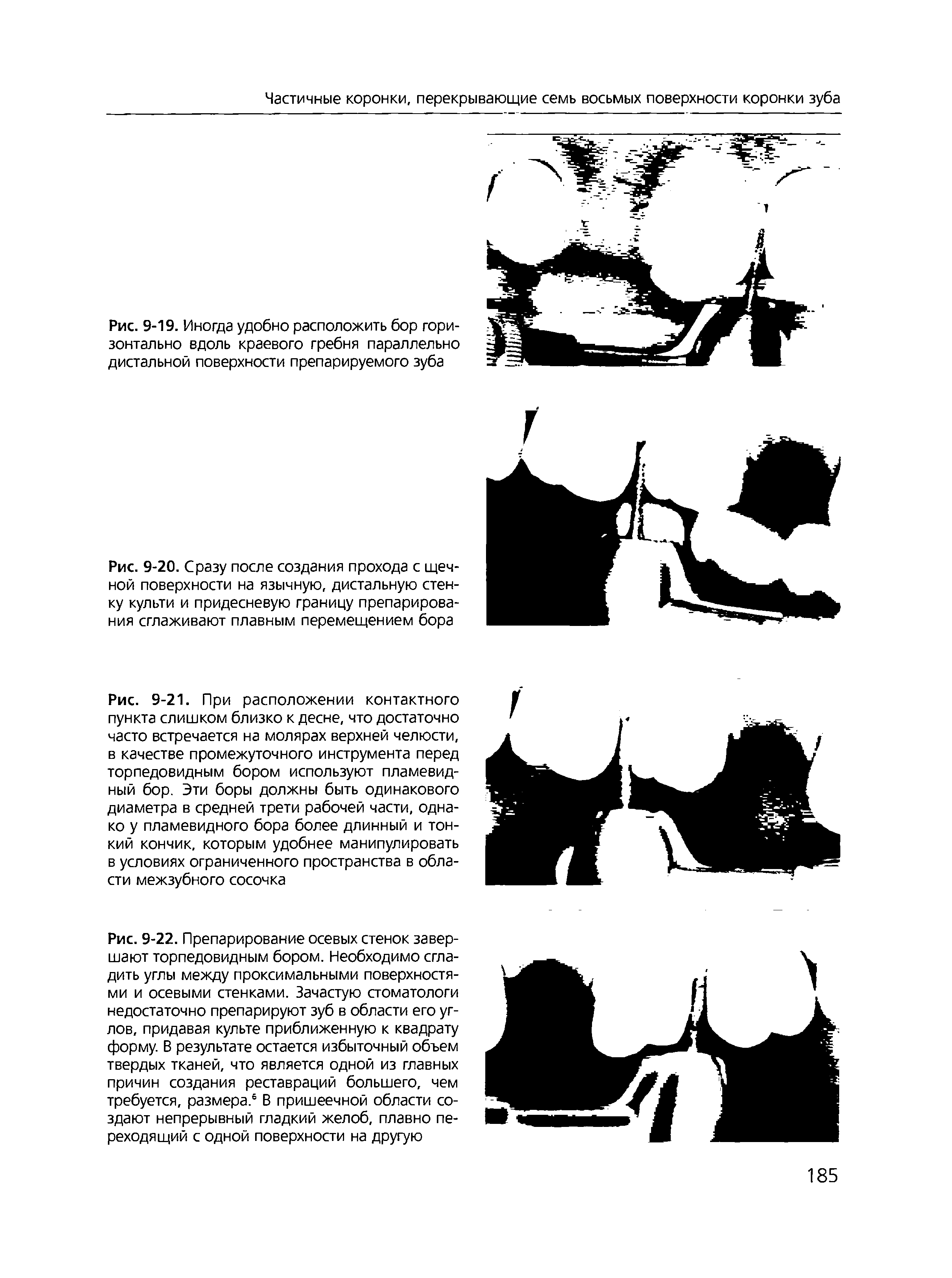 Рис. 9-20. Сразу после создания прохода с щечной поверхности на язычную, дистальную стенку культи и придесневую границу препарирования сглаживают плавным перемещением бора...
