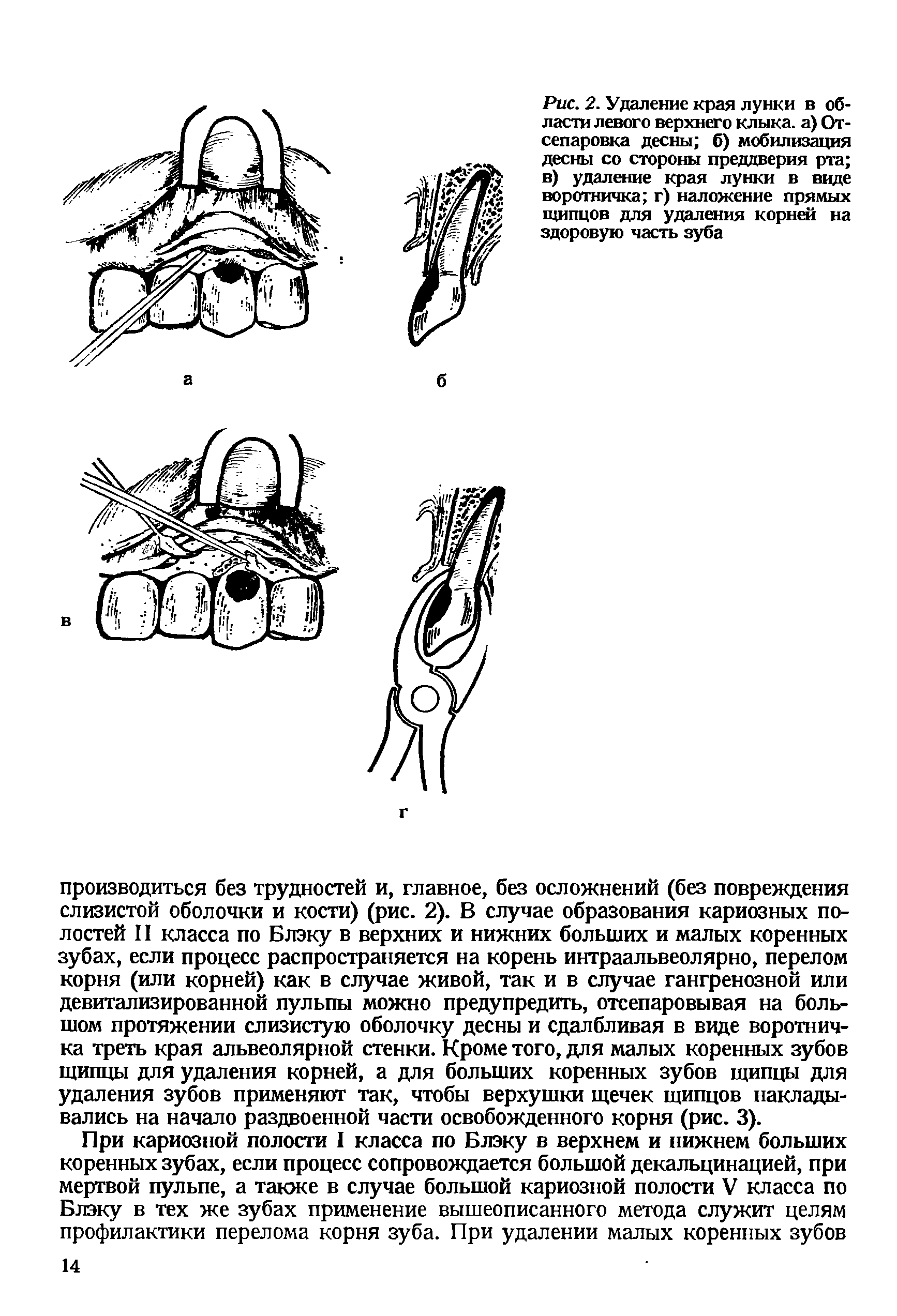 Рис. 2. Удаление края лунки в области левого верхнего клыка, а) От-сепаровка десны б) мобилизация десны со стороны преддверия рта в) удаление края лунки в виде воротничка г) наложение прямых щипцов для удаления корней на здоровую часть зуба...