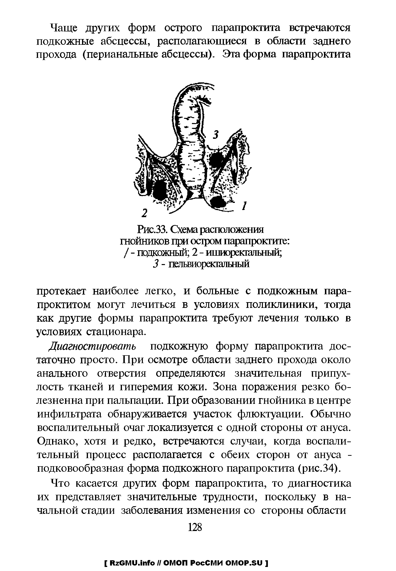 Рис.33. Схема расположения гнойников при остром парапроктите / - подкожный 2 - ишиоректальный ...