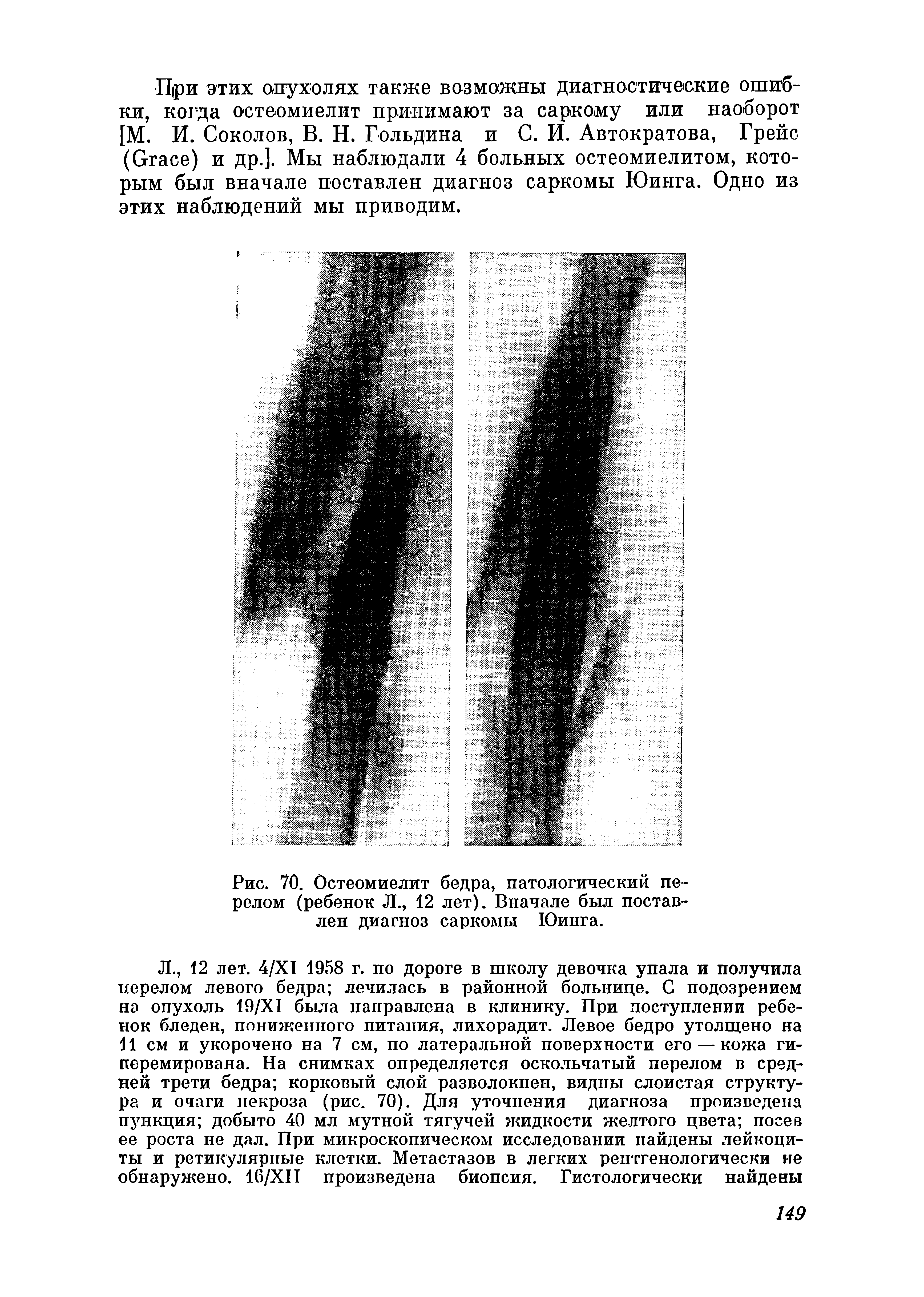 Рис. 70. Остеомиелит бедра, патологический перелом (ребенок Л., 12 лет). Вначале был поставлен диагноз саркомы Юинга.