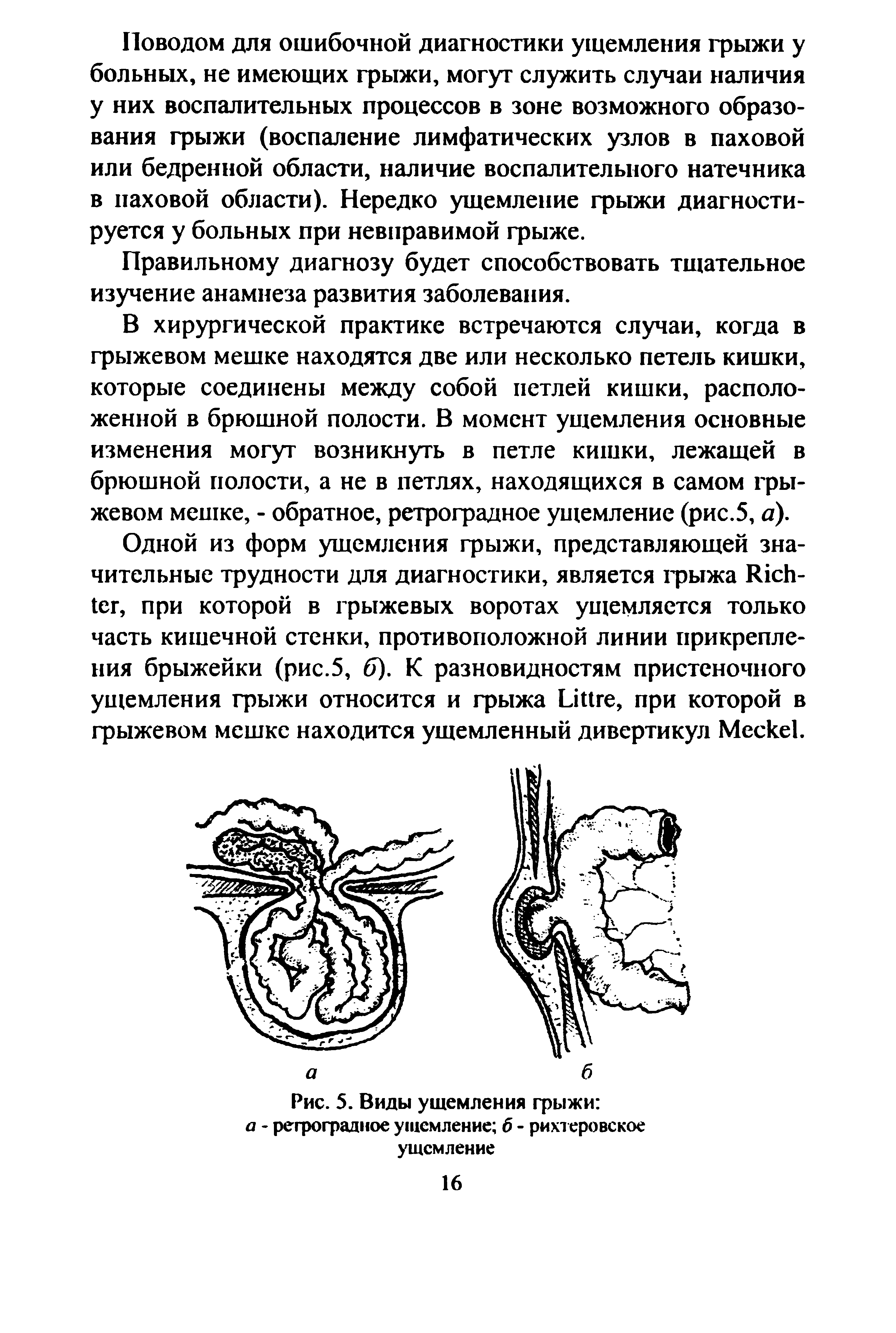 Рис. 5. Виды ущемления грыжи а - ретроградное ущемление б - рихтеровское ущемление...