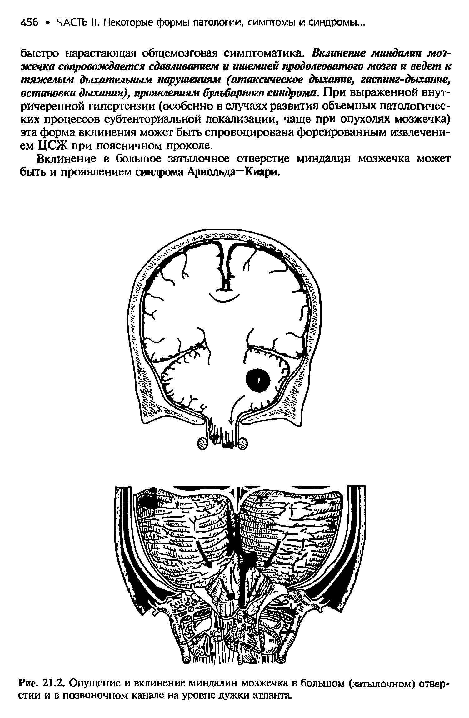 Рис. 21.2. Опущение и вклинение миндалин мозжечка в большом (затылочном) отверстии и в позвоночном канале на уровне дужки атланта.