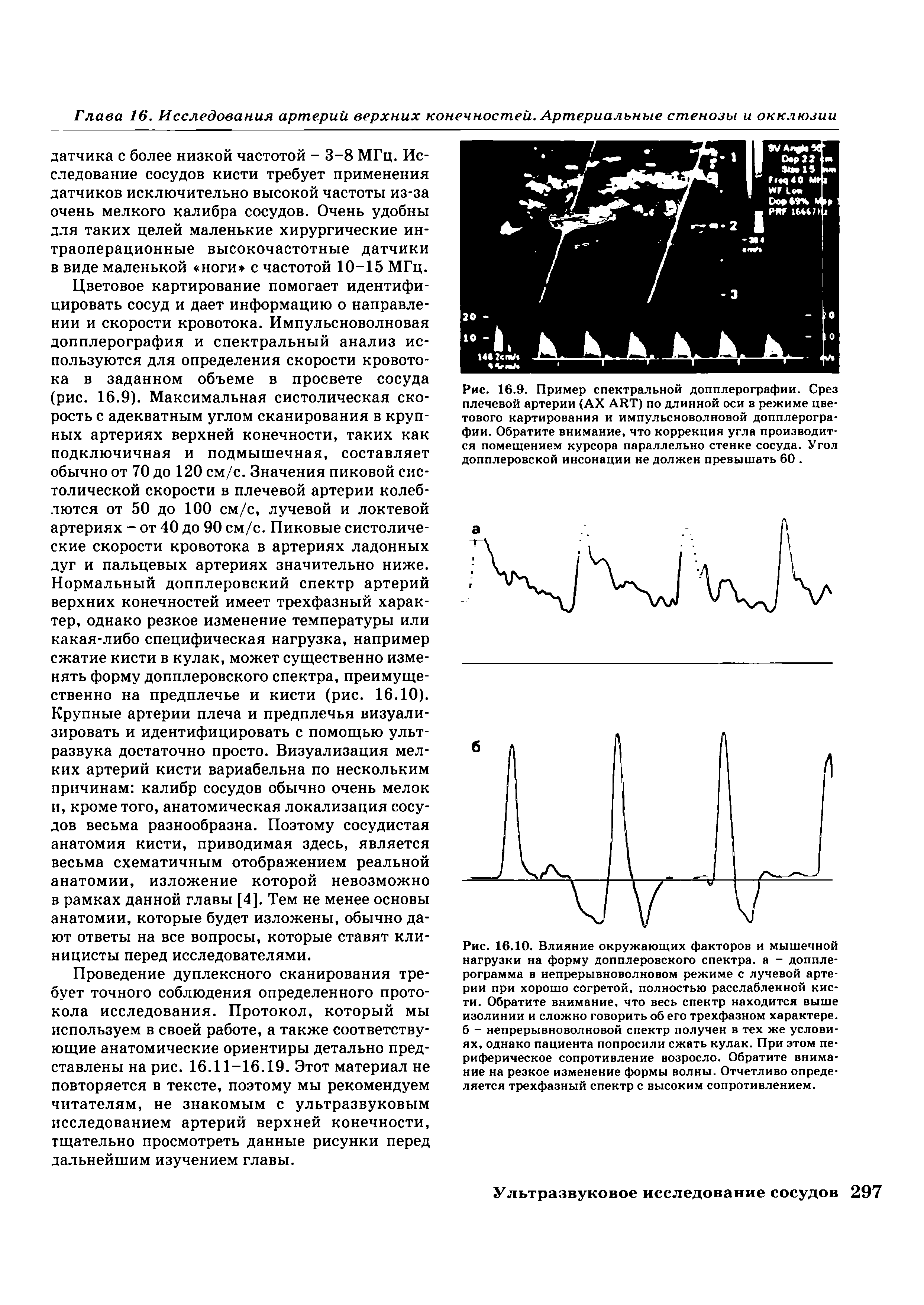Рис. 16.9. Пример спектральной допплерографии. Срез плечевой артерии (АХ ART) по длинной оси в режиме цветового картирования и импульсноволновой допплерографии. Обратите внимание, что коррекция угла производится помещением курсора параллельно стенке сосуда. Угол допплеровской инсонации не должен превышать 60. ...