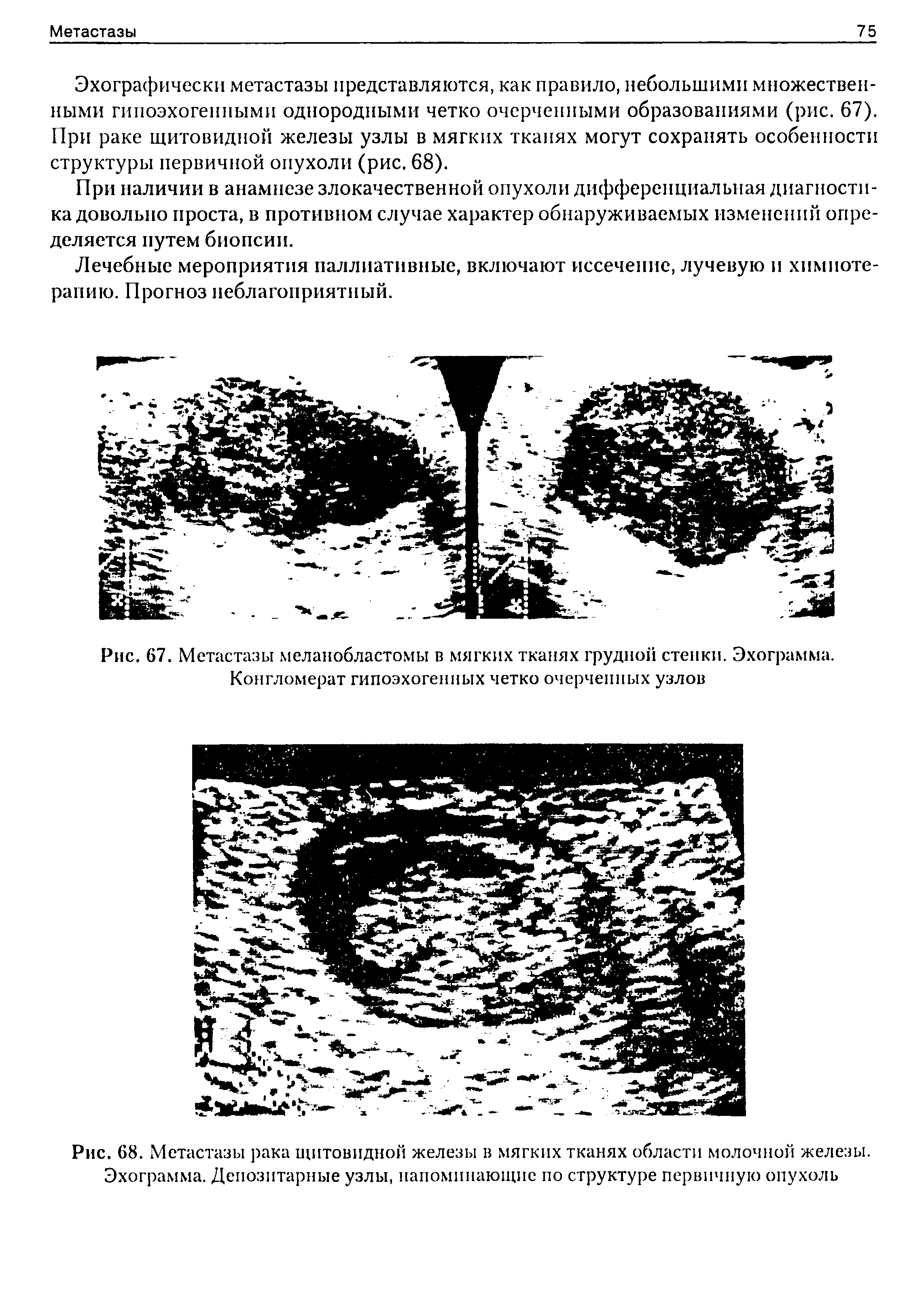 Рис. 67. Метастазы меланобластомы в мягких тканях грудной стенки. Эхограмма. Конгломерат гипоэхогенных четко очерченных узлов...