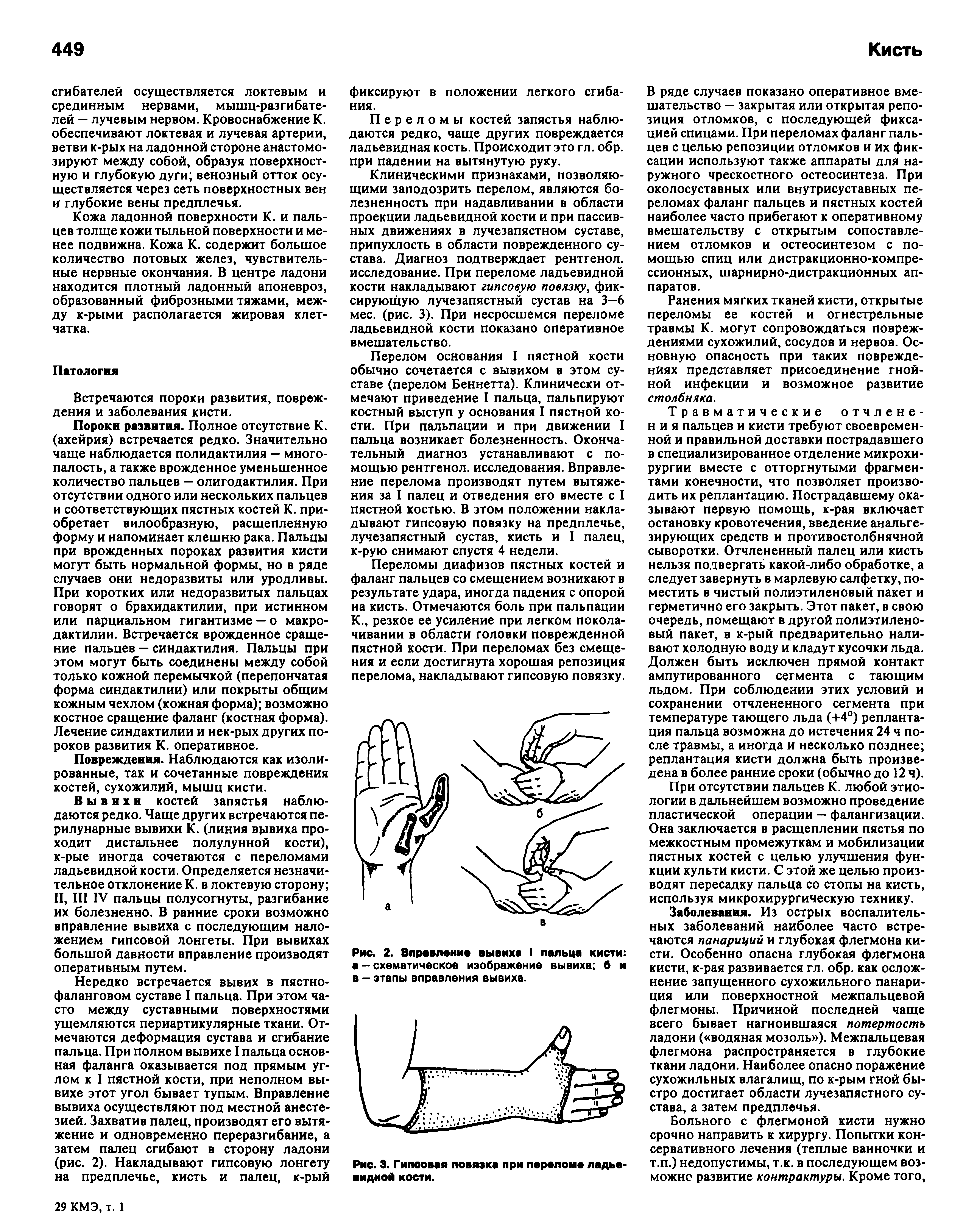 Рис. 2. Вправление вывиха I пальца кисти а - схематическое изображение вывиха б и в — этапы вправления вывиха.