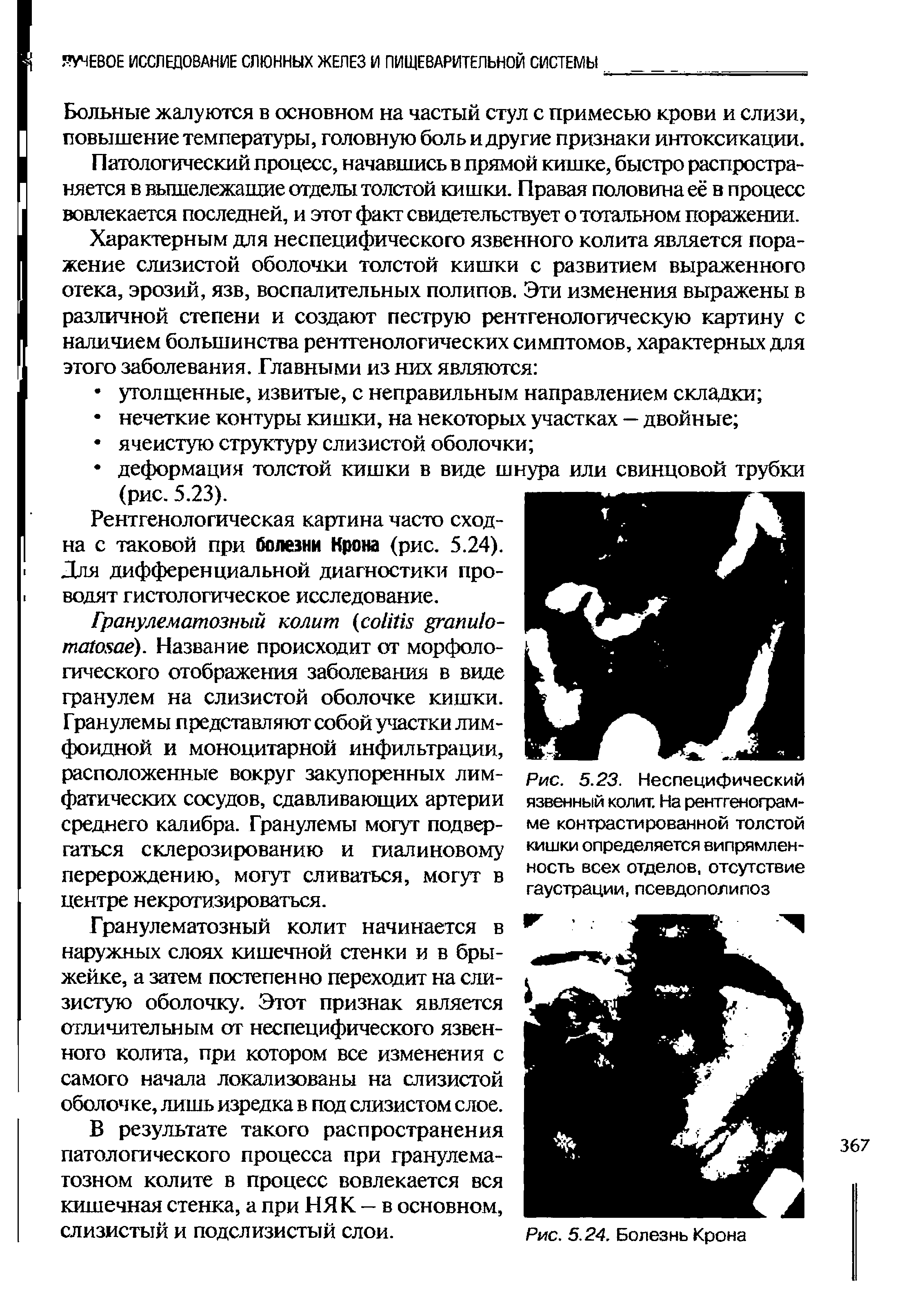 Рис. 5.23. Неспецифический язвенный колит. На рентгенограмме контрастированной толстой кишки определяется випрямлен-ность всех отделов, отсутствие гаустрации, псевдополипоз...