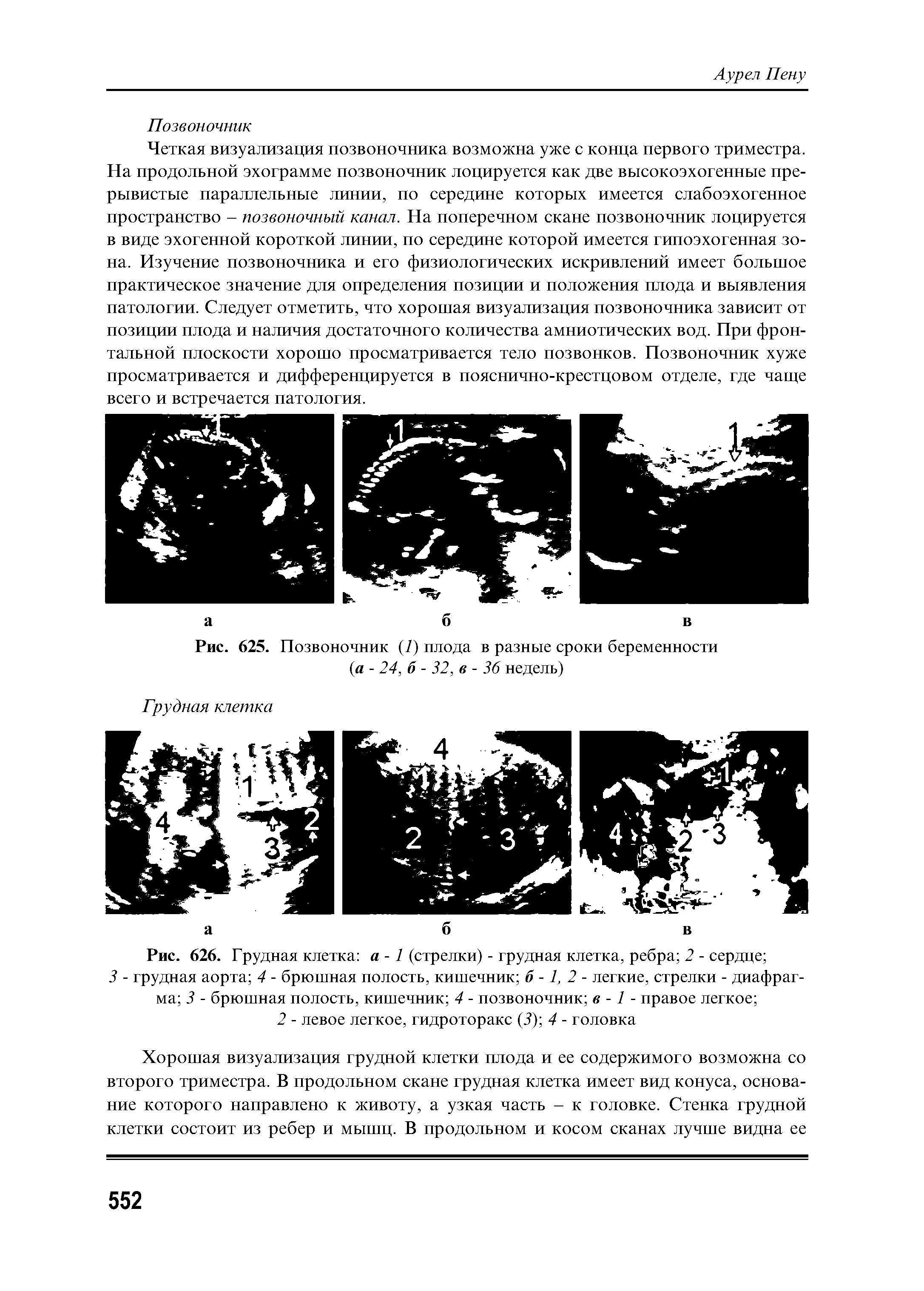 Рис. 626. Грудная клетка а -1 (стрелки) - грудная клетка, ребра 2 - сердце ...