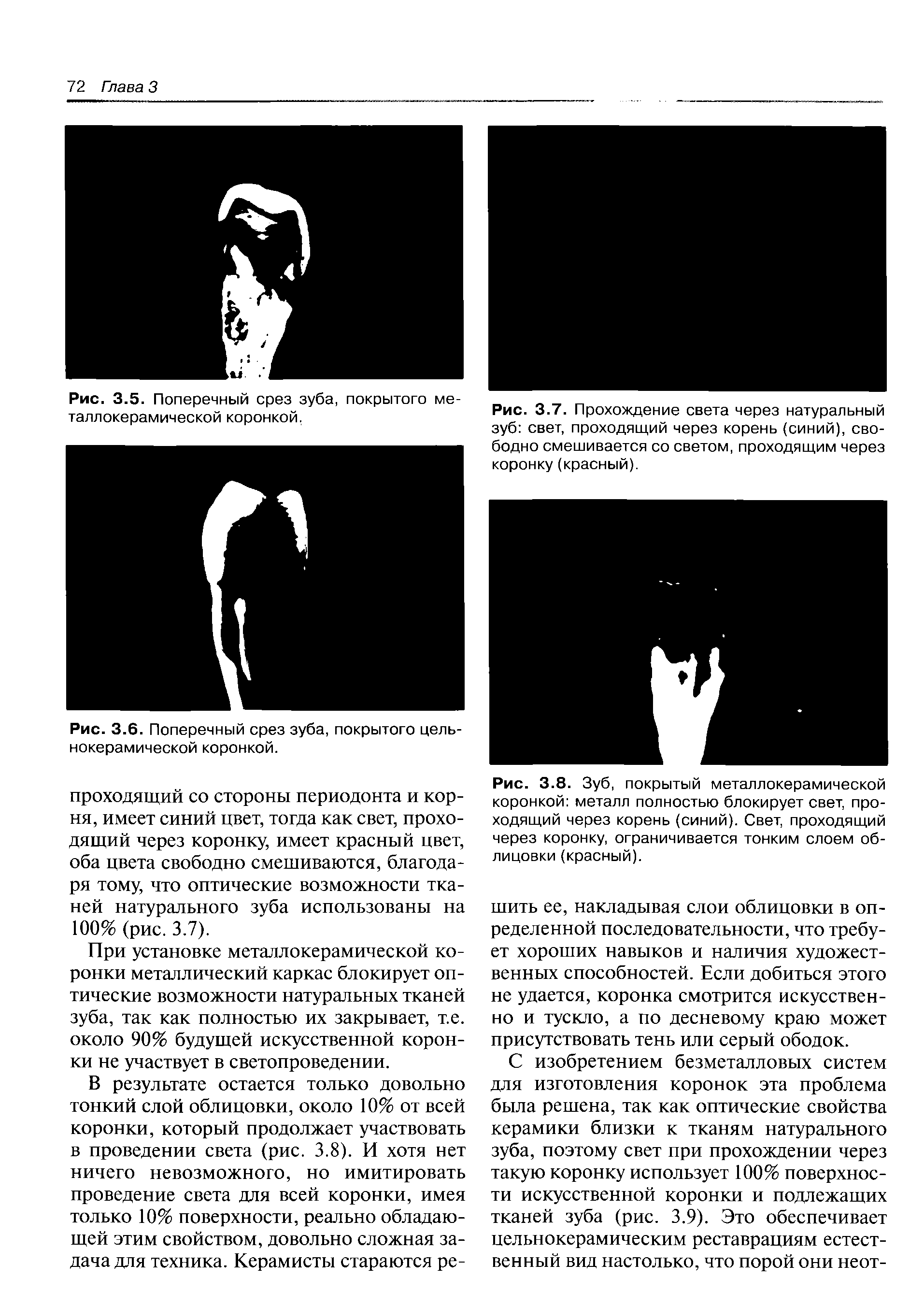 Рис. 3.8. Зуб, покрытый металлокерамической коронкой металл полностью блокирует свет, проходящий через корень (синий). Свет, проходящий через коронку, ограничивается тонким слоем облицовки (красный).