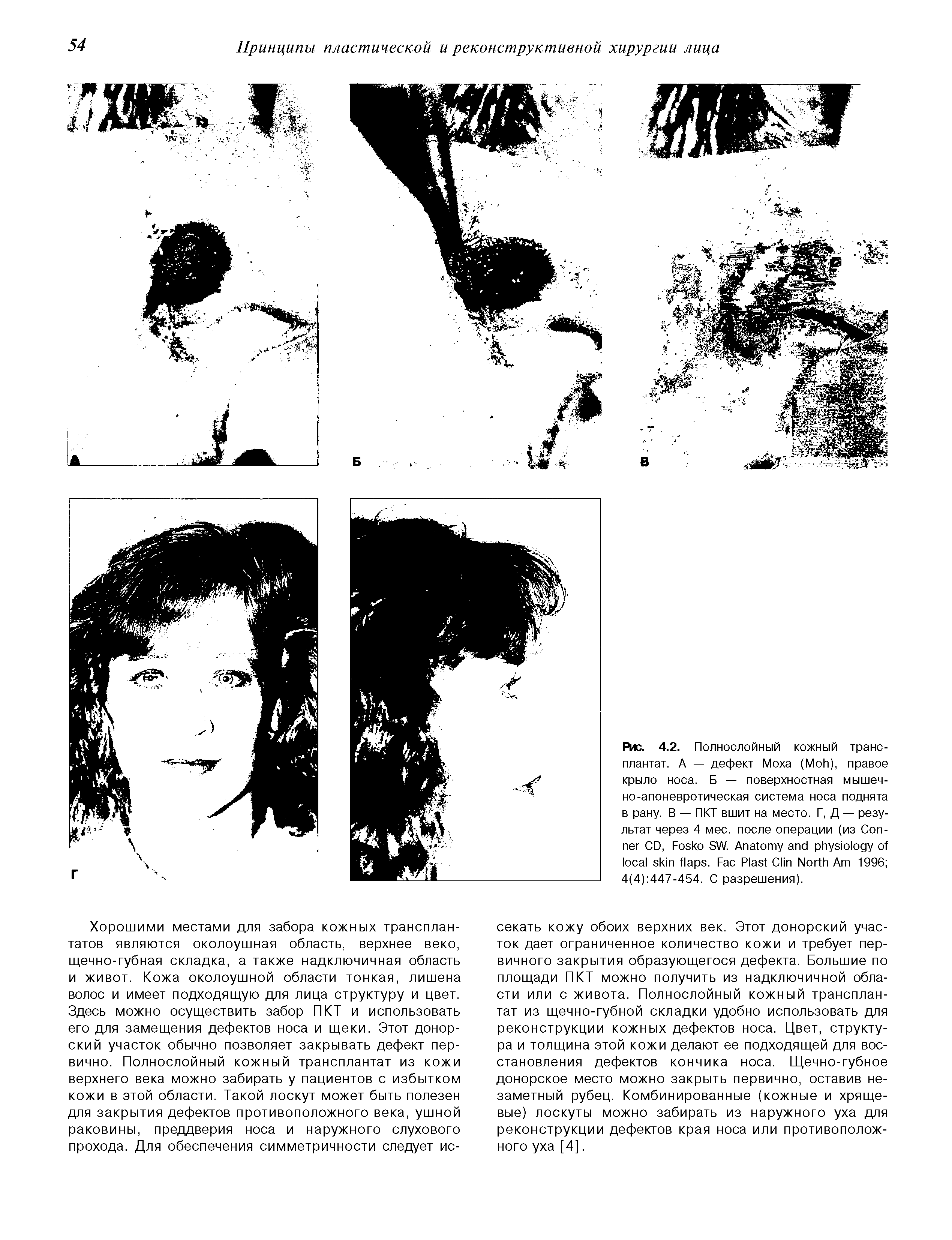 Рис. 4.2. Полнослойный кожный трансплантат. А — дефект Моха (M ), правое крыло носа. Б — поверхностная мышечно-апоневротическая система носа поднята в рану. В — ПКТ вшит на место. Г, Д — результат через 4 мес. после операции (из C CD, F SW. A . F P C N A 1996 4(4) 447-454. С разрешения).