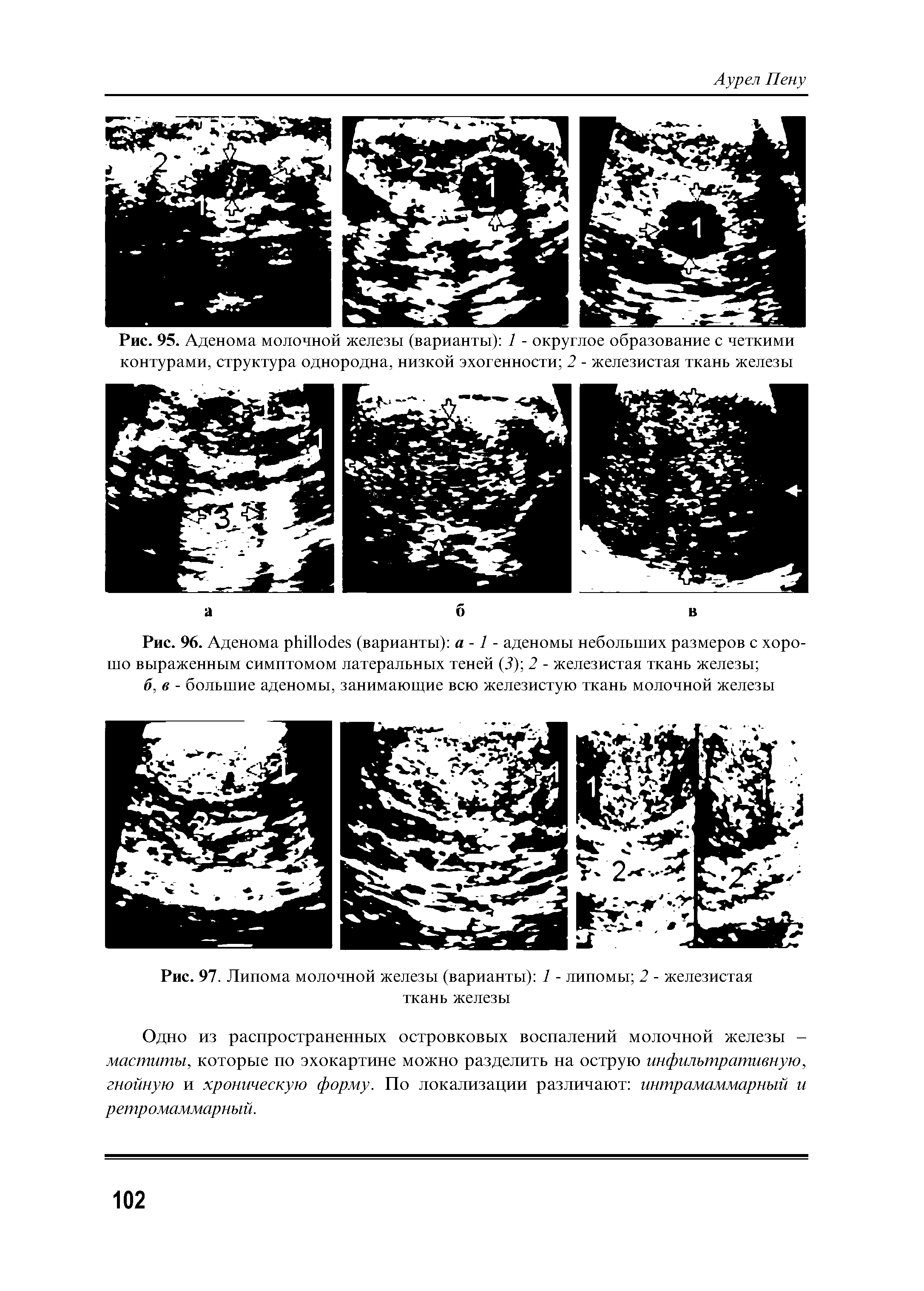 Рис. 97. Липома молочной железы (варианты) 1 - липомы 2 - железистая ткань железы...