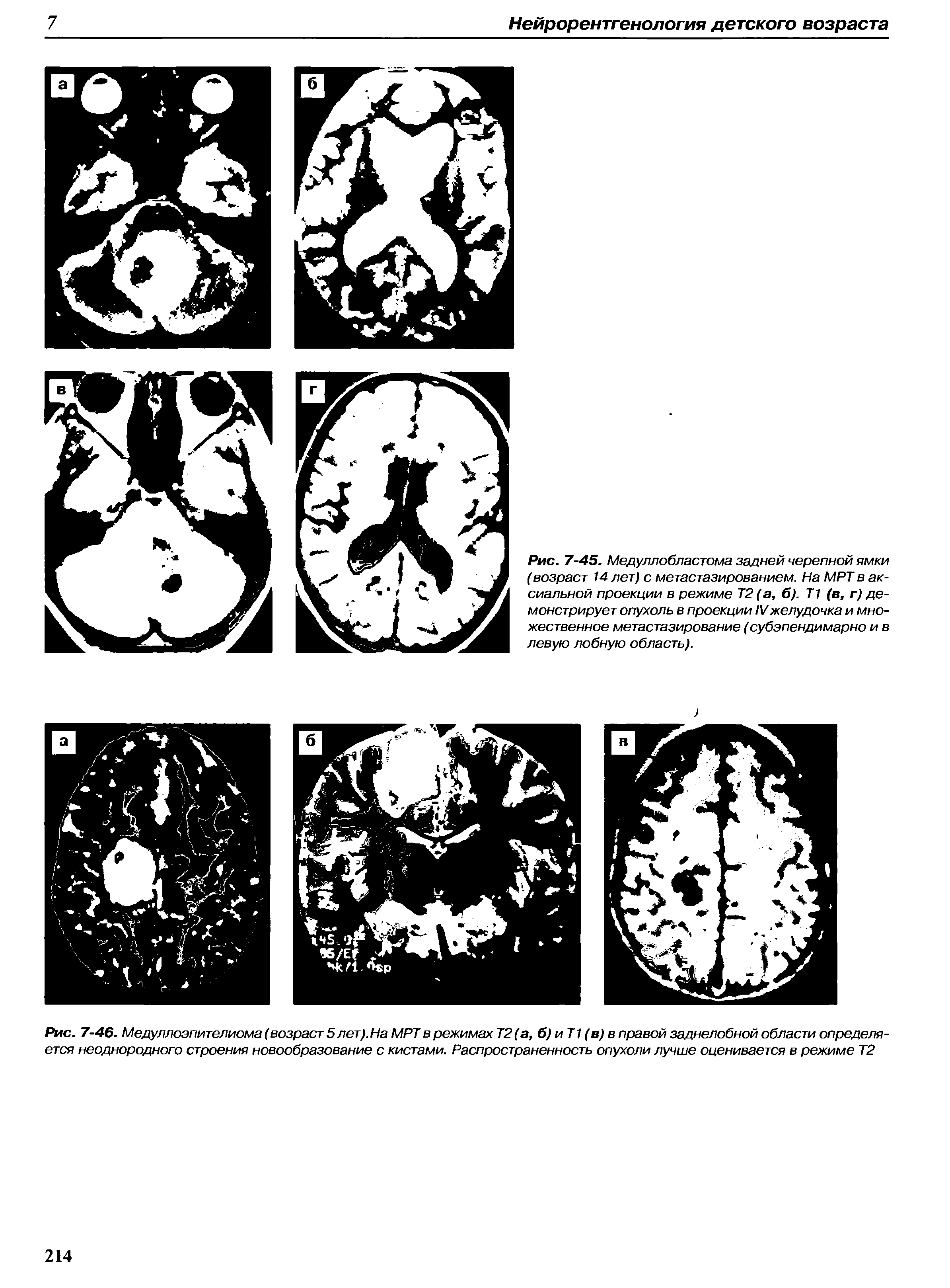 Рис. 7-46. Медуллоэпителиома (возраст 5 лет). На МРТ в режимах Т2(а, б) и Т1 (в) в правой заднелобной области определяется неоднородного строения новообразование с кистами. Распространенность опухоли лучше оценивается в режиме Т2...