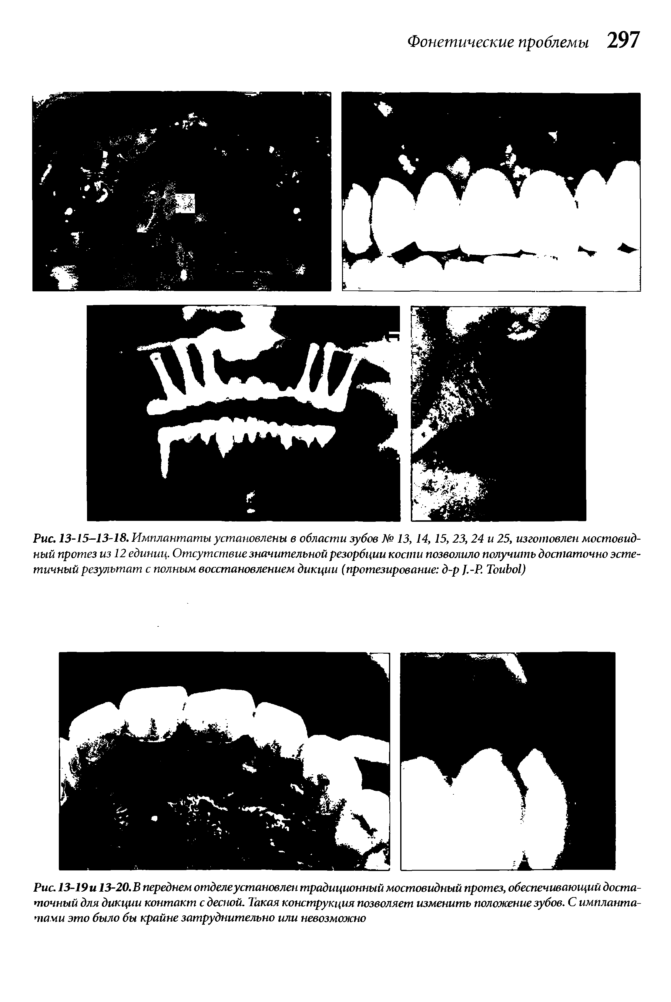 Рис. 13-19и 13-20.В переднем отделе установлен традиционный мостовидный протез, обеспечивающий достаточный для дикции контакт с десной. Такая конструкция позволяет изменить положение зубов. С имплантатами это было бы крайне затруднительно или невозможно...