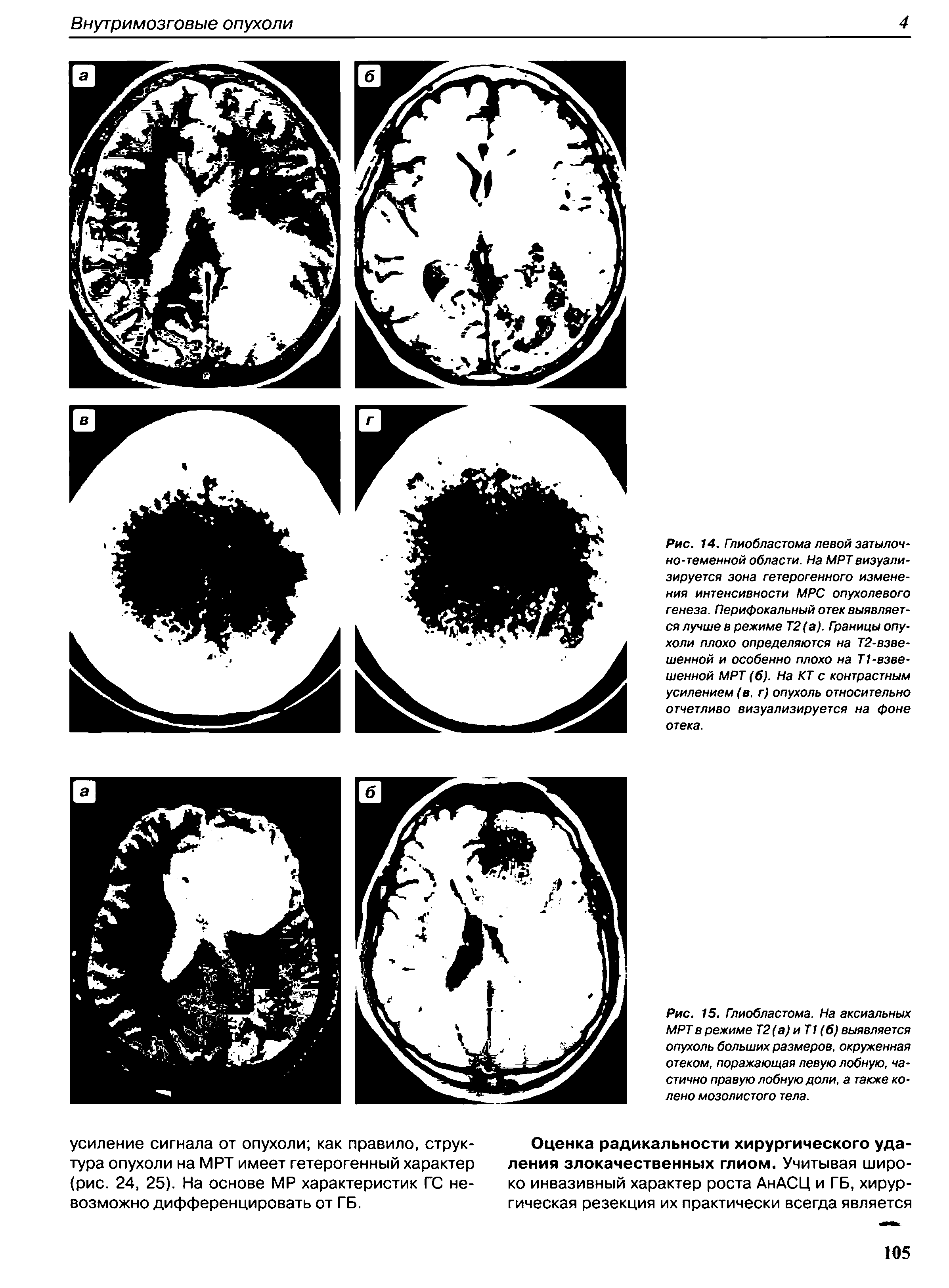 Рис. 15. Глиобластома. На аксиальных МРТв режиме Т2(а) иТ1 (б) выявляется опухоль больших размеров, окруженная отеком, поражающая левую лобную, частично правую лобную доли, а также колено мозолистого тела.