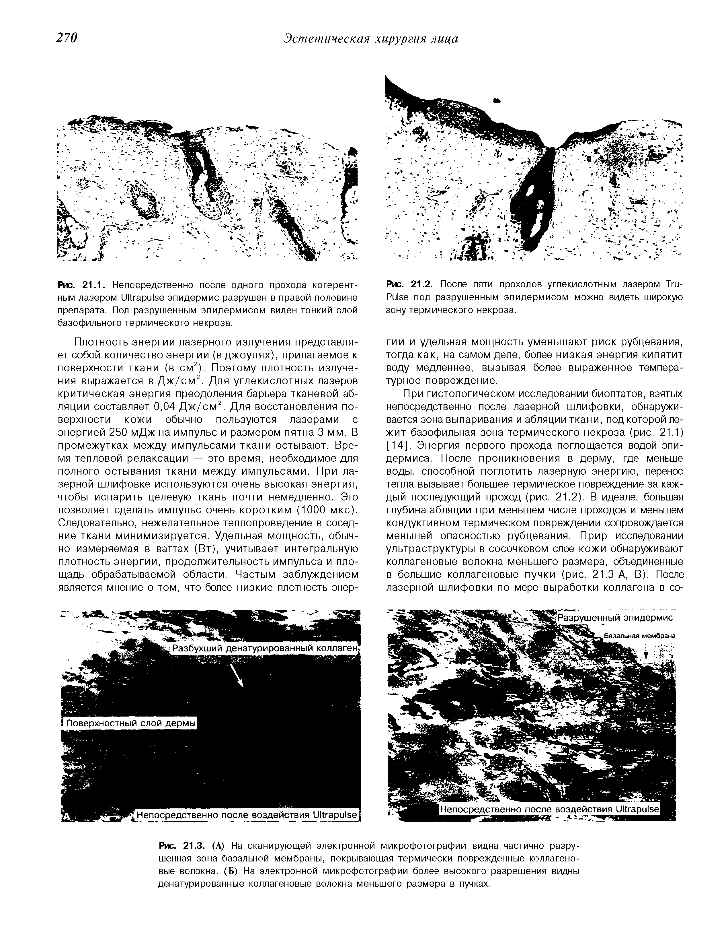 Рис. 21.3. (А) На сканирующей электронной микрофотографии видна частично разрушенная зона базальной мембраны, покрывающая термически поврежденные коллагеновые волокна. (Б) На электронной микрофотографии более высокого разрешения видны денатурированные коллагеновые волокна меньшего размера в пучках.