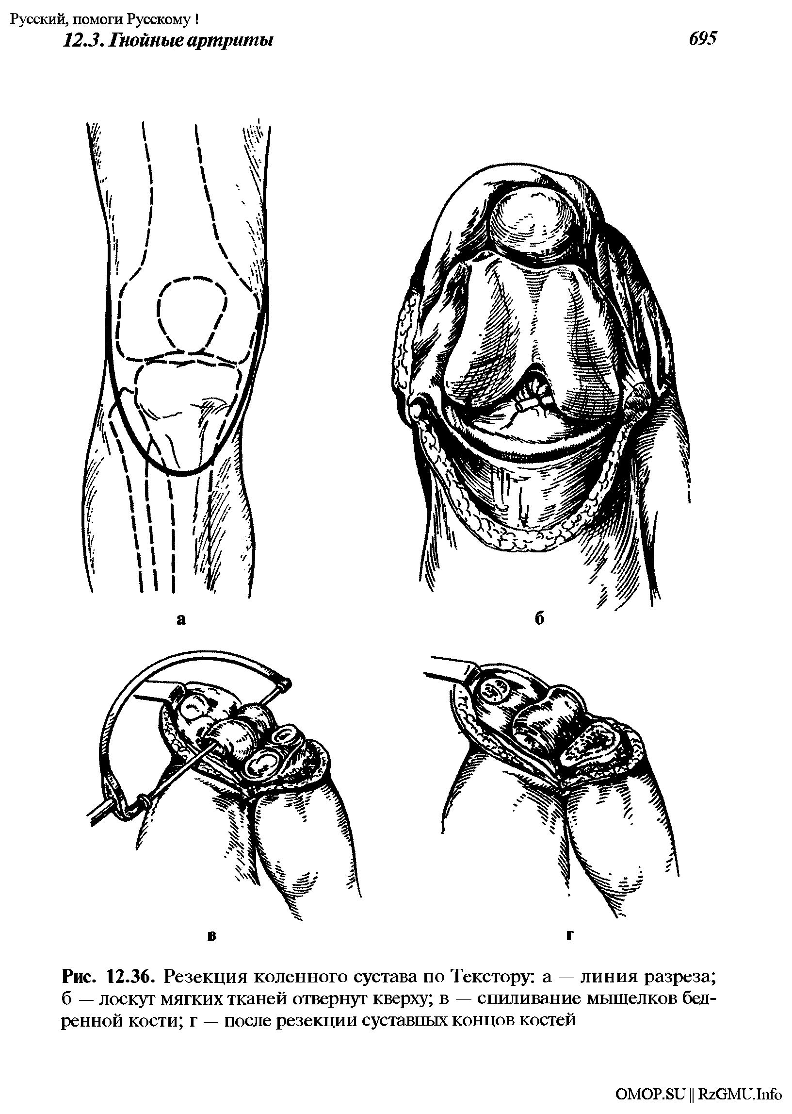 Резекция б сальника