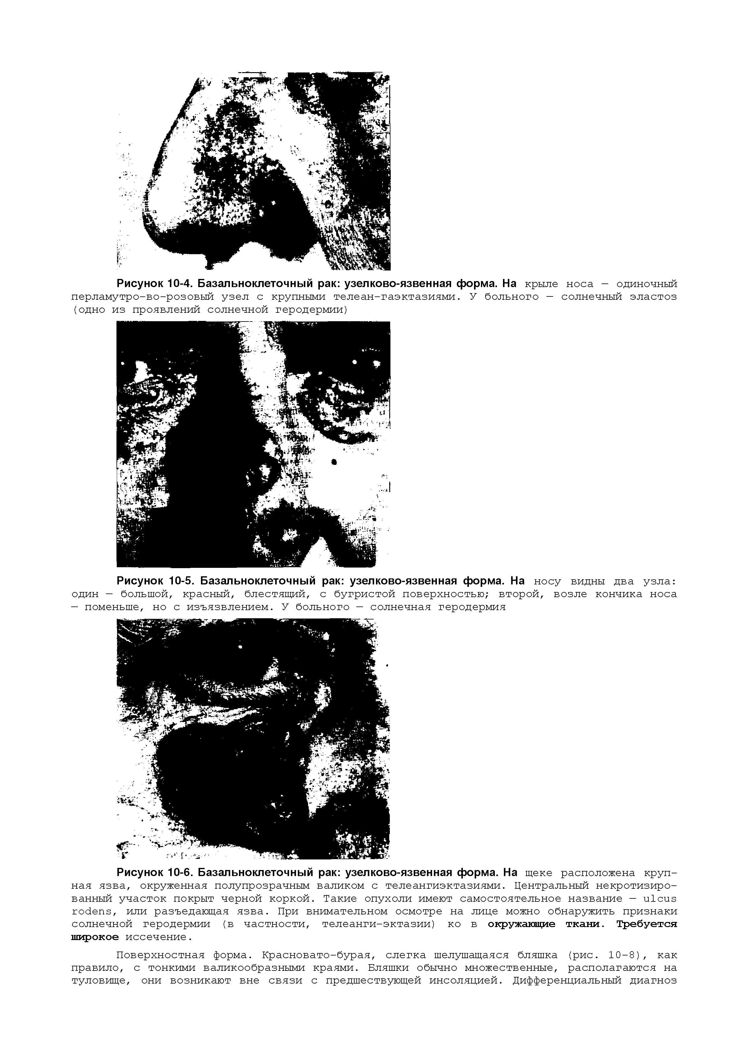 Рисунок 10-5. Базальноклеточный рак узелково-язвенная форма. На носу видны два узла один — большой, красный, блестящий, с бугристой поверхностью второй, возле кончика носа — поменьше, но с изъязвлением. У больного — солнечная геродермия...