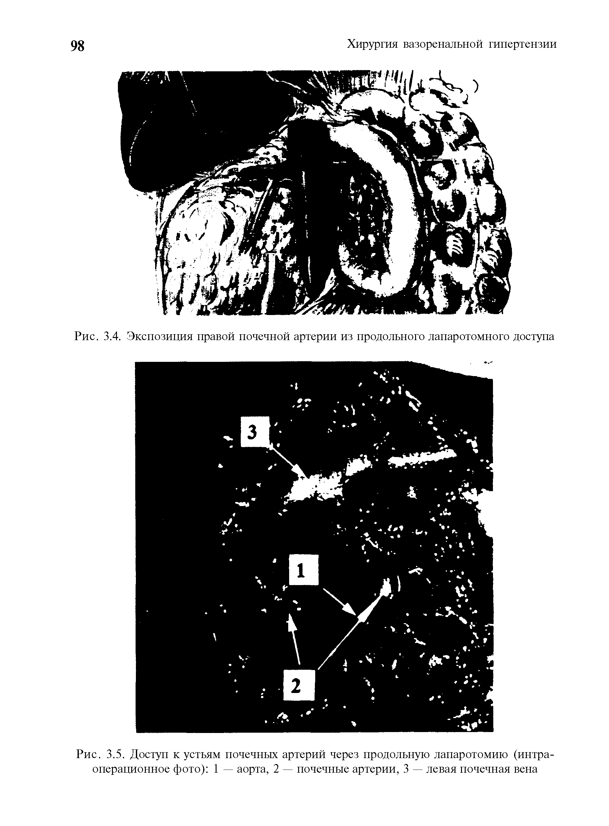 Рис. 3.5. Доступ к устьям почечных артерий через продольную лапаротомию (интраоперационное фото) 1 — аорта, 2 — почечные артерии, 3 — левая почечная вена...