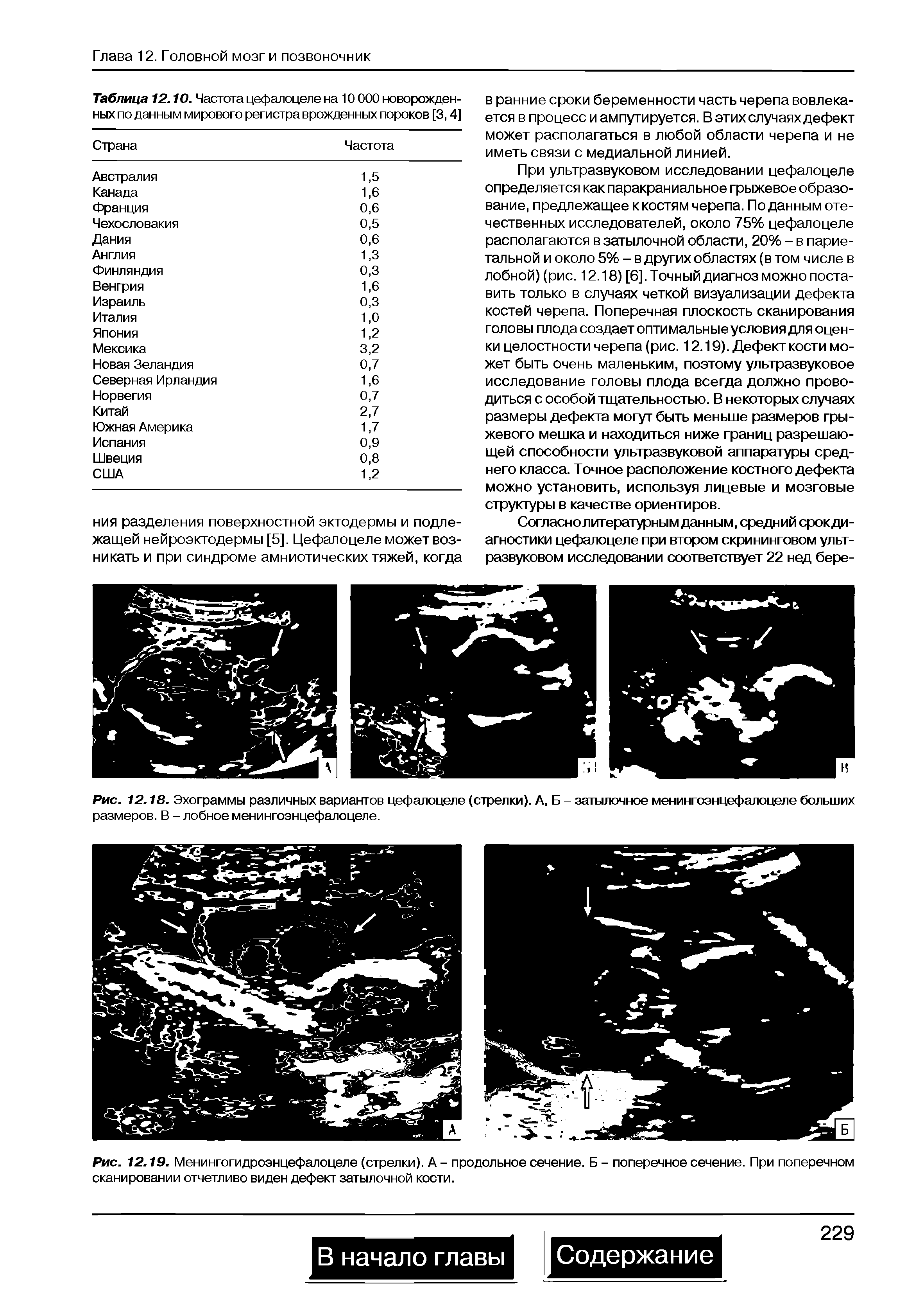 Рис. 12.18. Эхограммы различных вариантов цефалоцеле (стрелки). А, Б - затылочное менингоэнцефалоцеле больших размеров. В - лобное менингоэнцефалоцеле.