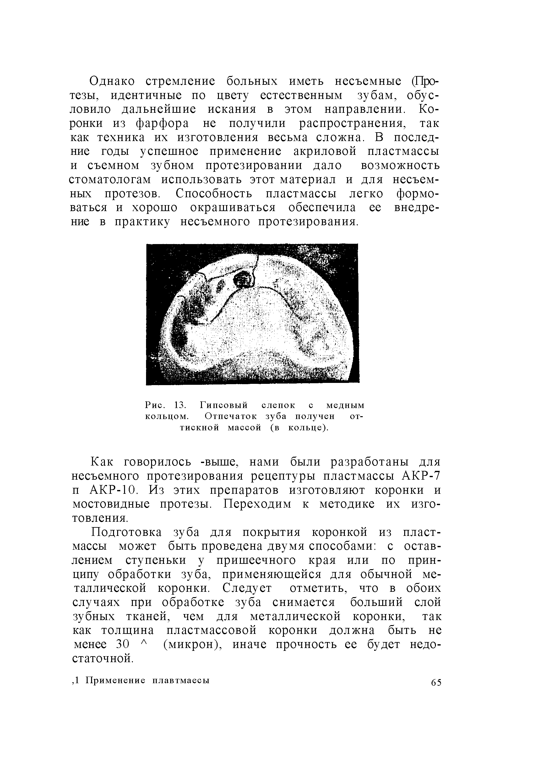 Рис. 13. Гипсовый слепок с медным кольцом. Отпечаток зуба получен от-тискной массой (в кольце).