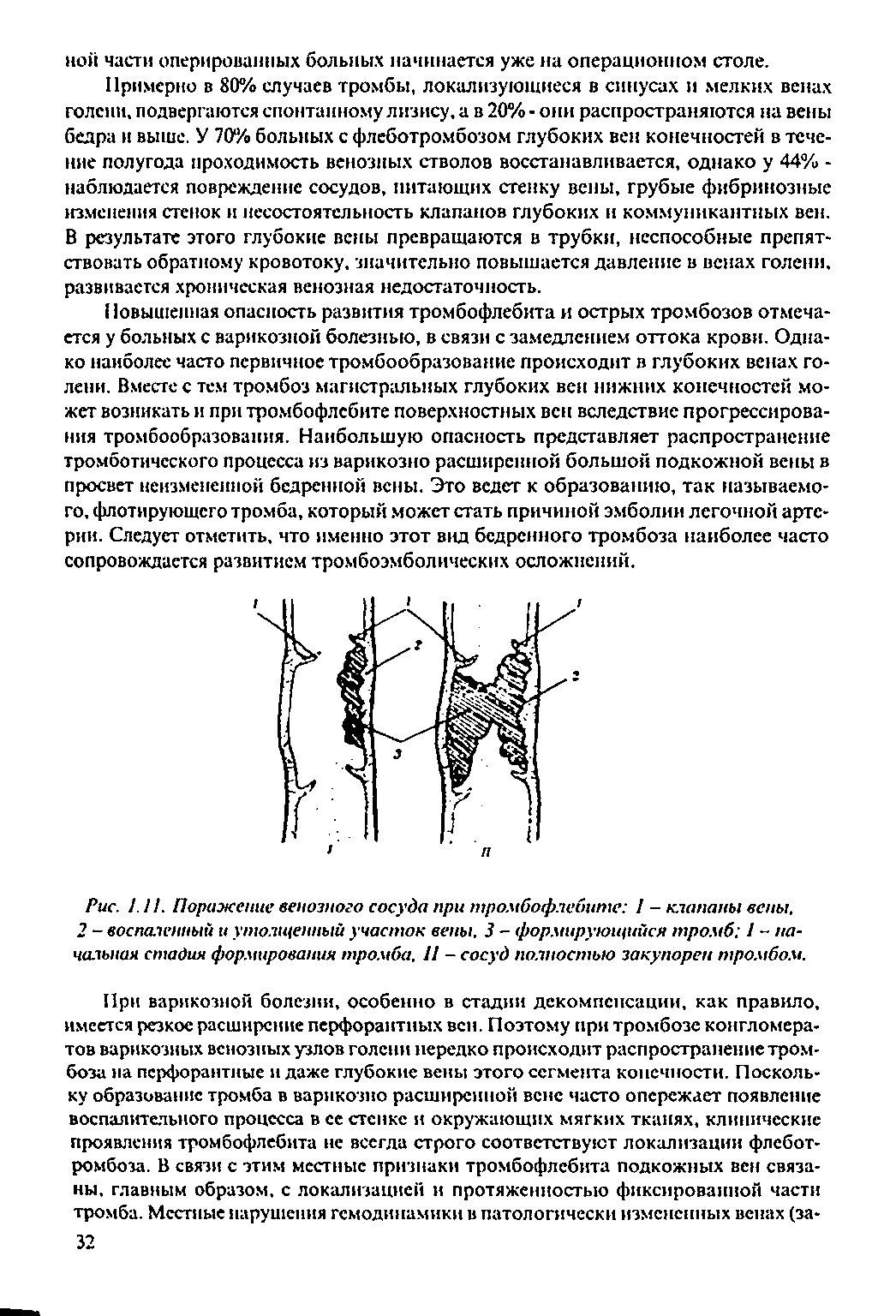 Рис. 1.11. Поражение венозного сосуда при тромбофлебите 1 - клапаны вены, 2 - воспаленный и утолщенный участок вены. 3 - формирующийся тромб 1 начальная стадия формирования тромба, 11 - сосуд полностью закупорен тромбом.