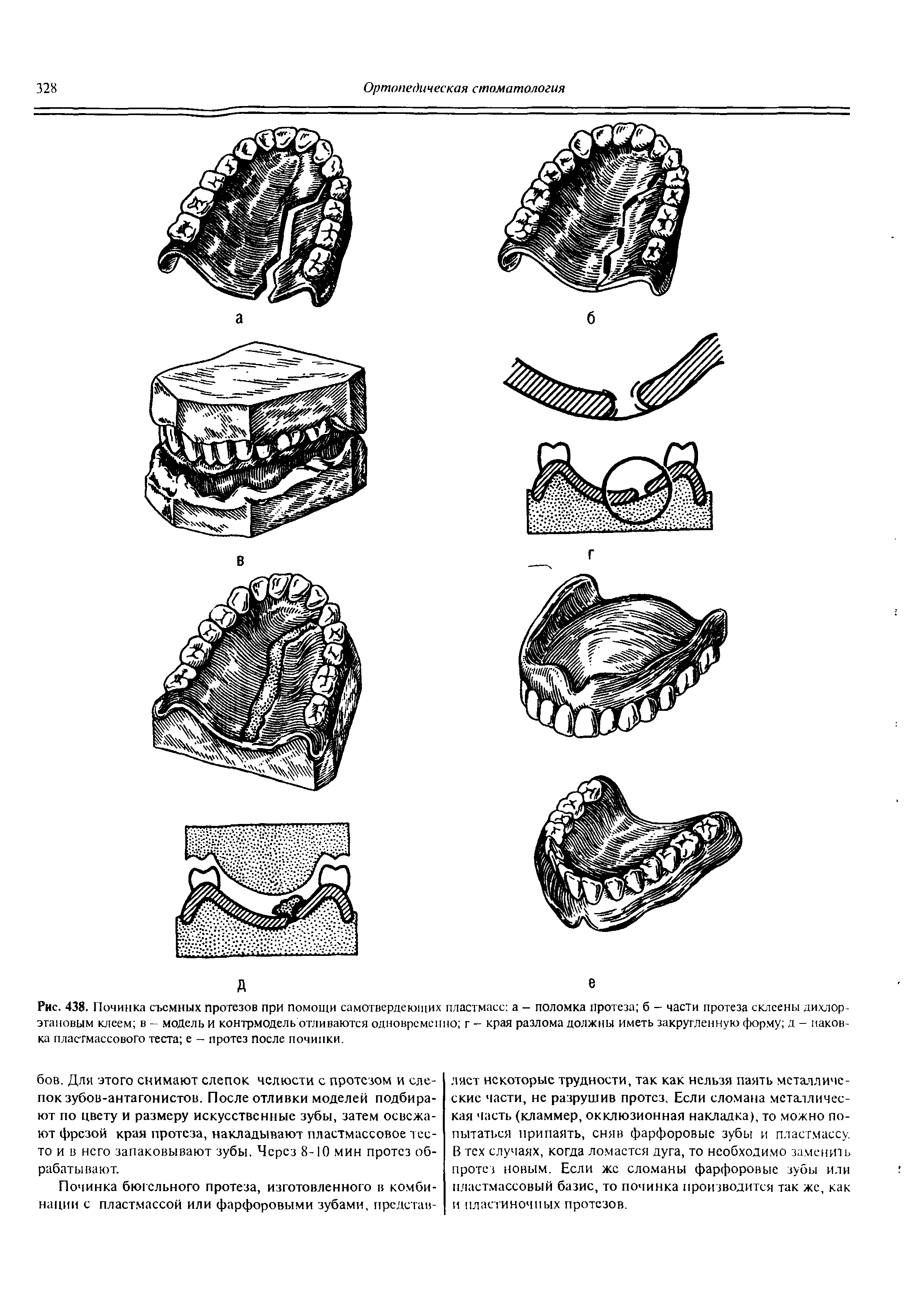 Рис. 438. Починка съемных протезов при помощи самотвердеющих пластмасс а - поломка протеза б - части протеза склеены дихлор-этановым клеем в - модель и контрмодель отливаются одновременно г - края разлома должны иметь закругленную форму д - наковка пластмассового теста е - протез после починки.