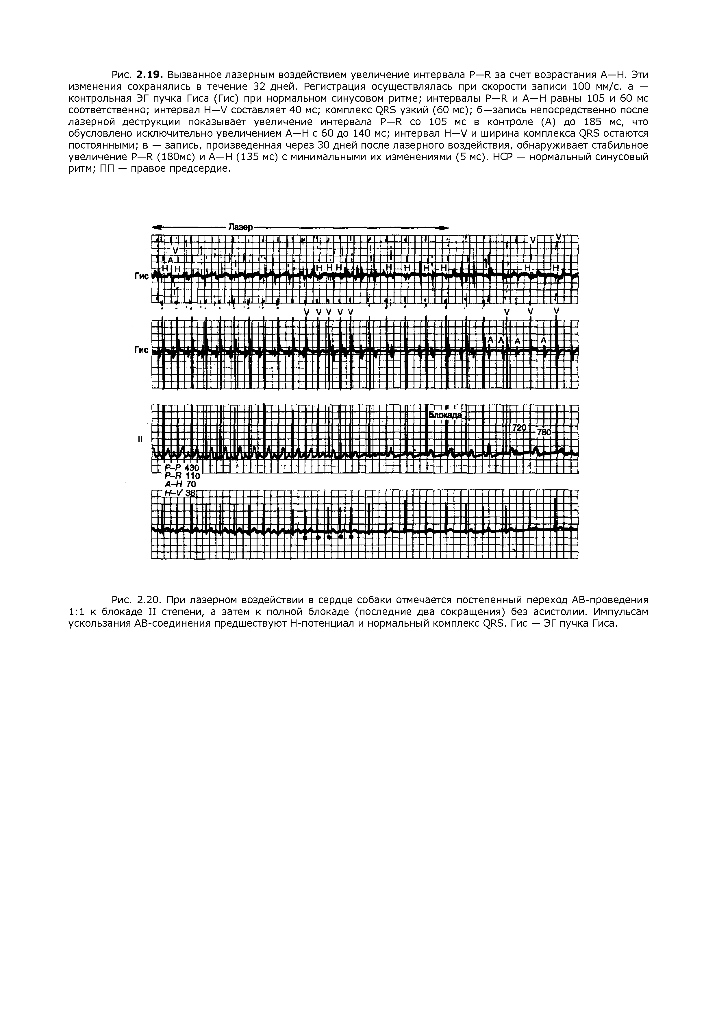 Рис. 2.20. При лазерном воздействии в сердце собаки отмечается постепенный переход АВ-проведения 1 1 к блокаде II степени, а затем к полной блокаде (последние два сокращения) без асистолии. Импульсам ускользания АВ-соединения предшествуют Н-потенциал и нормальный комплекс С Э. Гис — ЭГ пучка Гиса.