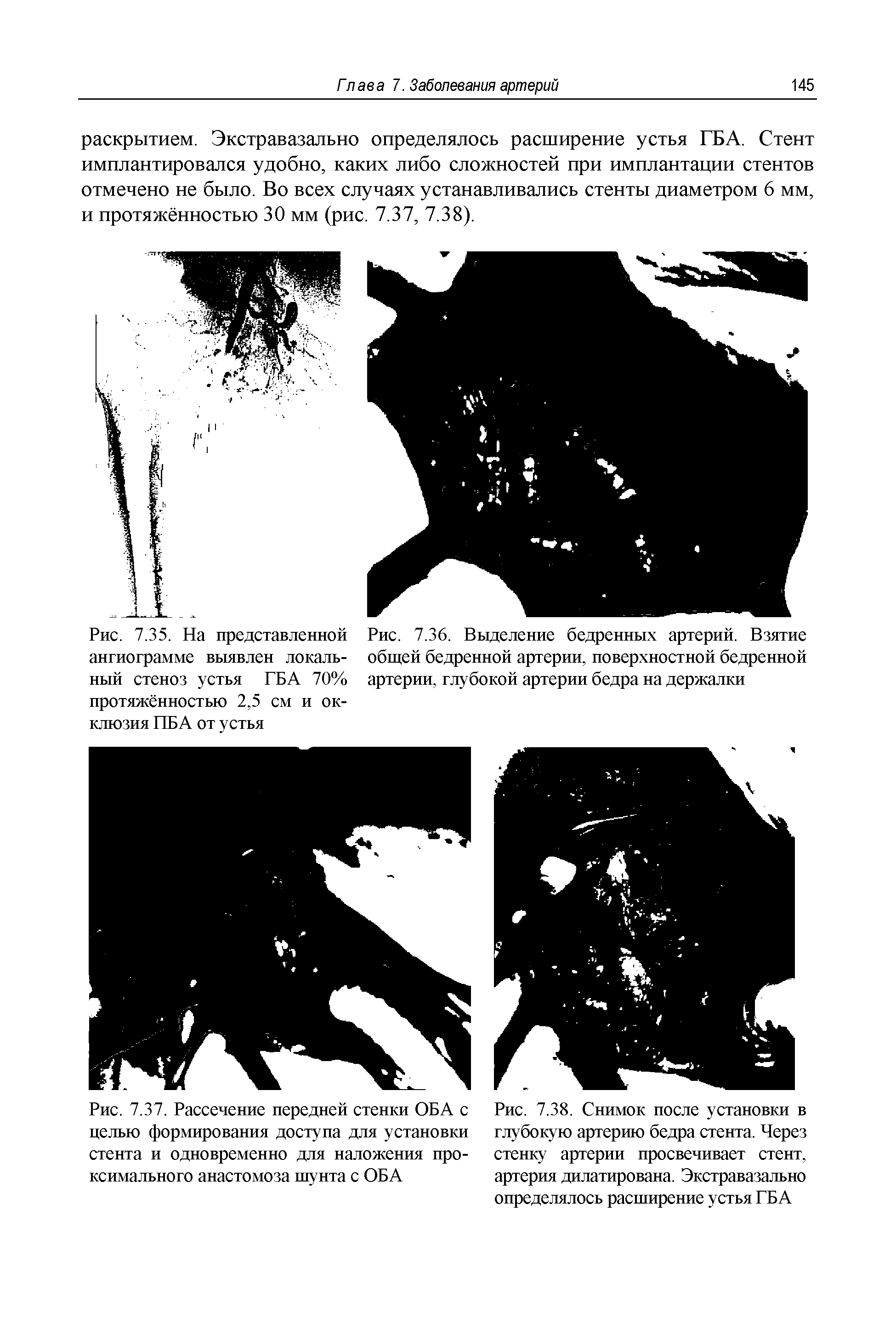 Рис. 7.36. Выделение бедренных артерий. Взятие общей бедренной артерии, поверхностной бедренной артерии, глубокой артерии бедра на держалки...