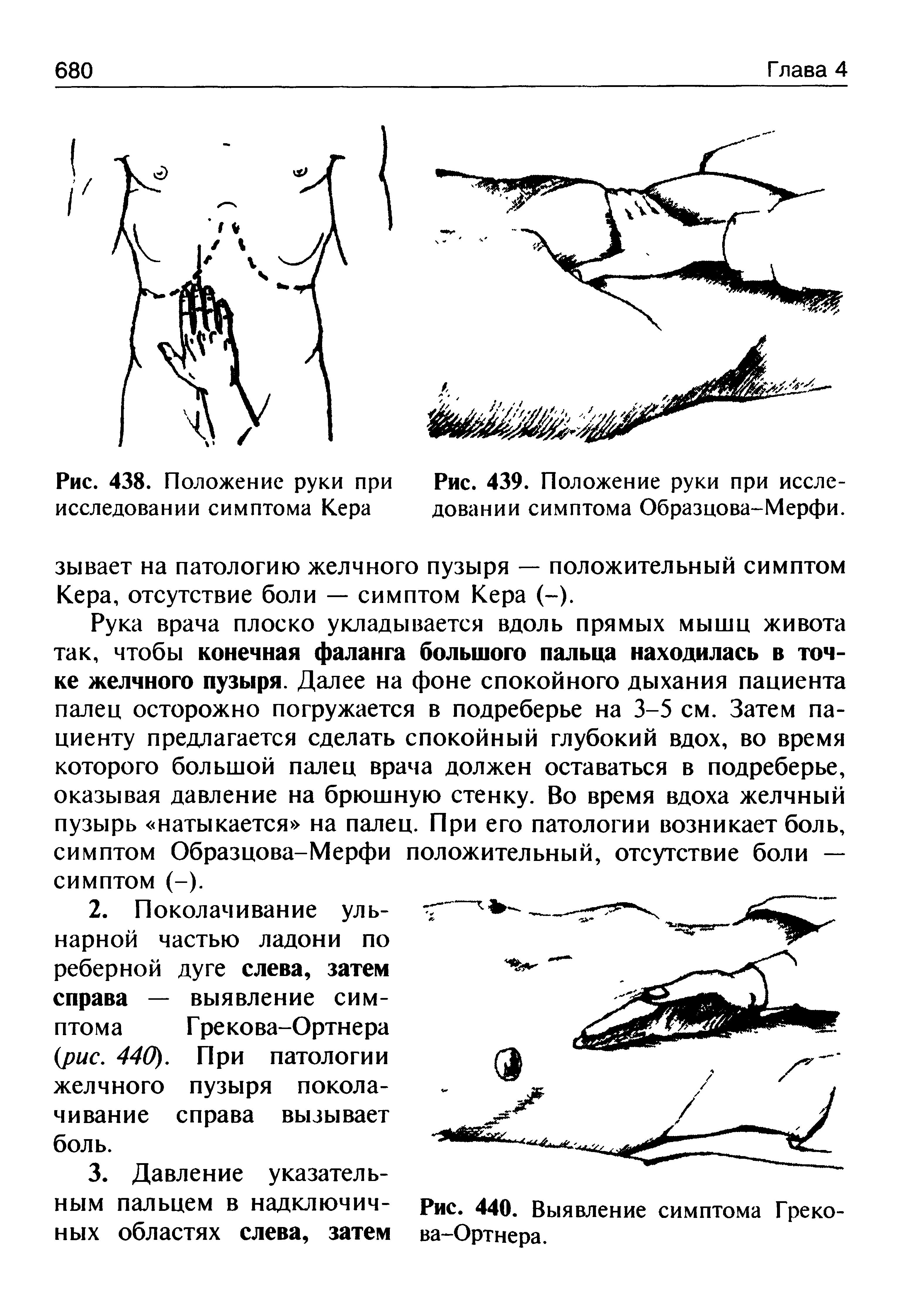 Рис. 439. Положение руки при исследовании симптома Образцова-Мерфи.