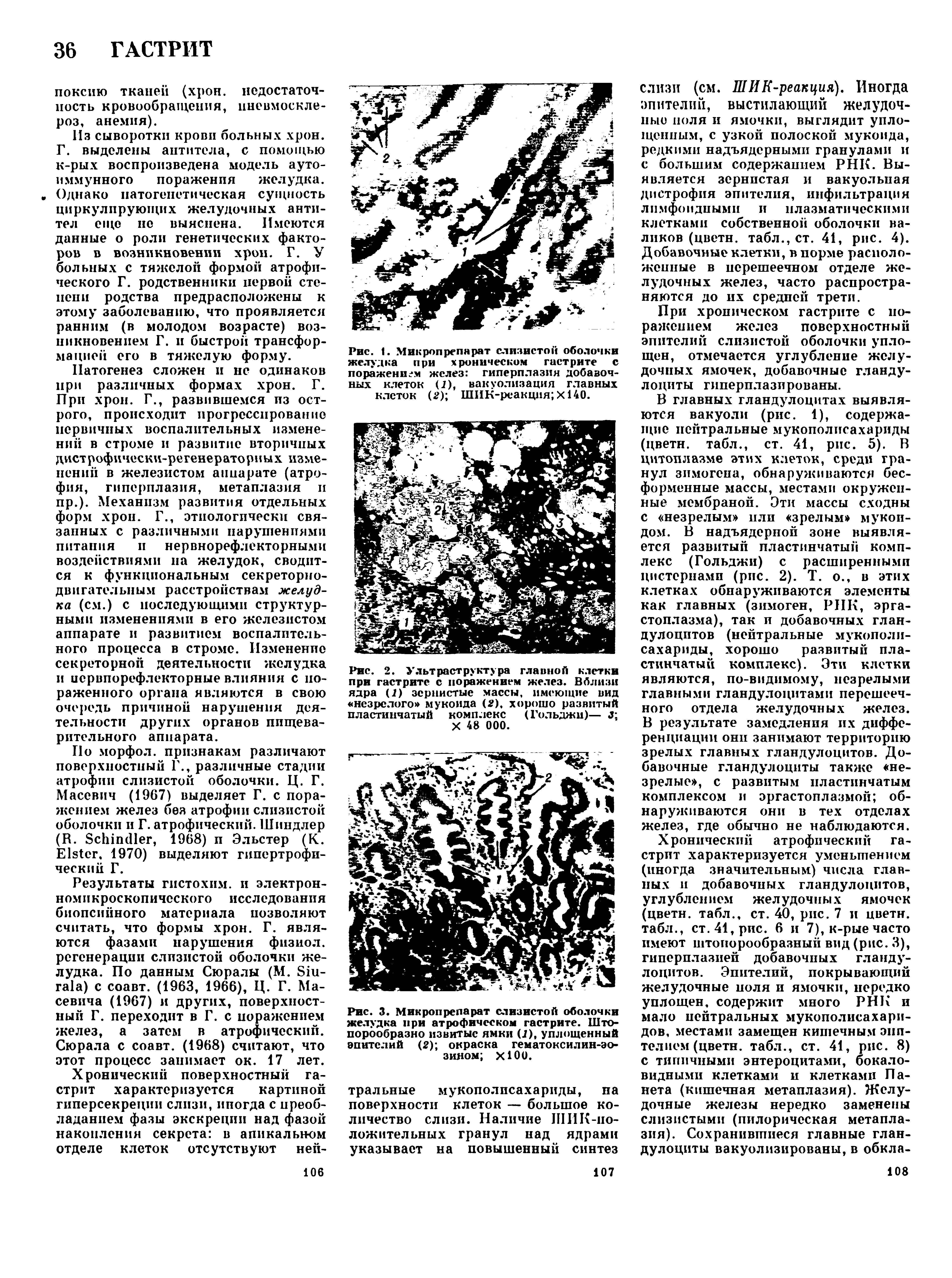 Рис. 1. Микропрепарат слизистой оболочки желудка при хроническом гастрите с поражением желез гиперплазия добавочных клеток (2), вакуолизация главных клеток ( ) ШИК-реакция X140.