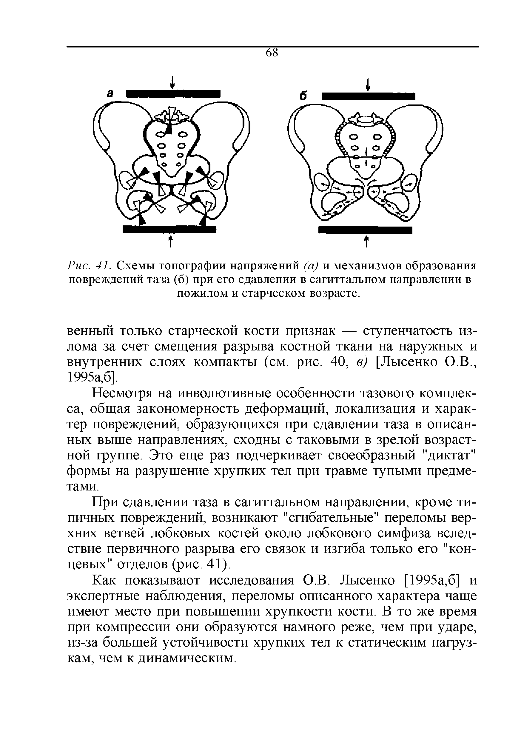 Рис. 41. Схемы топографии напряжений (а) и механизмов образования повреждений таза (б) при его сдавлении в сагиттальном направлении в пожилом и старческом возрасте.