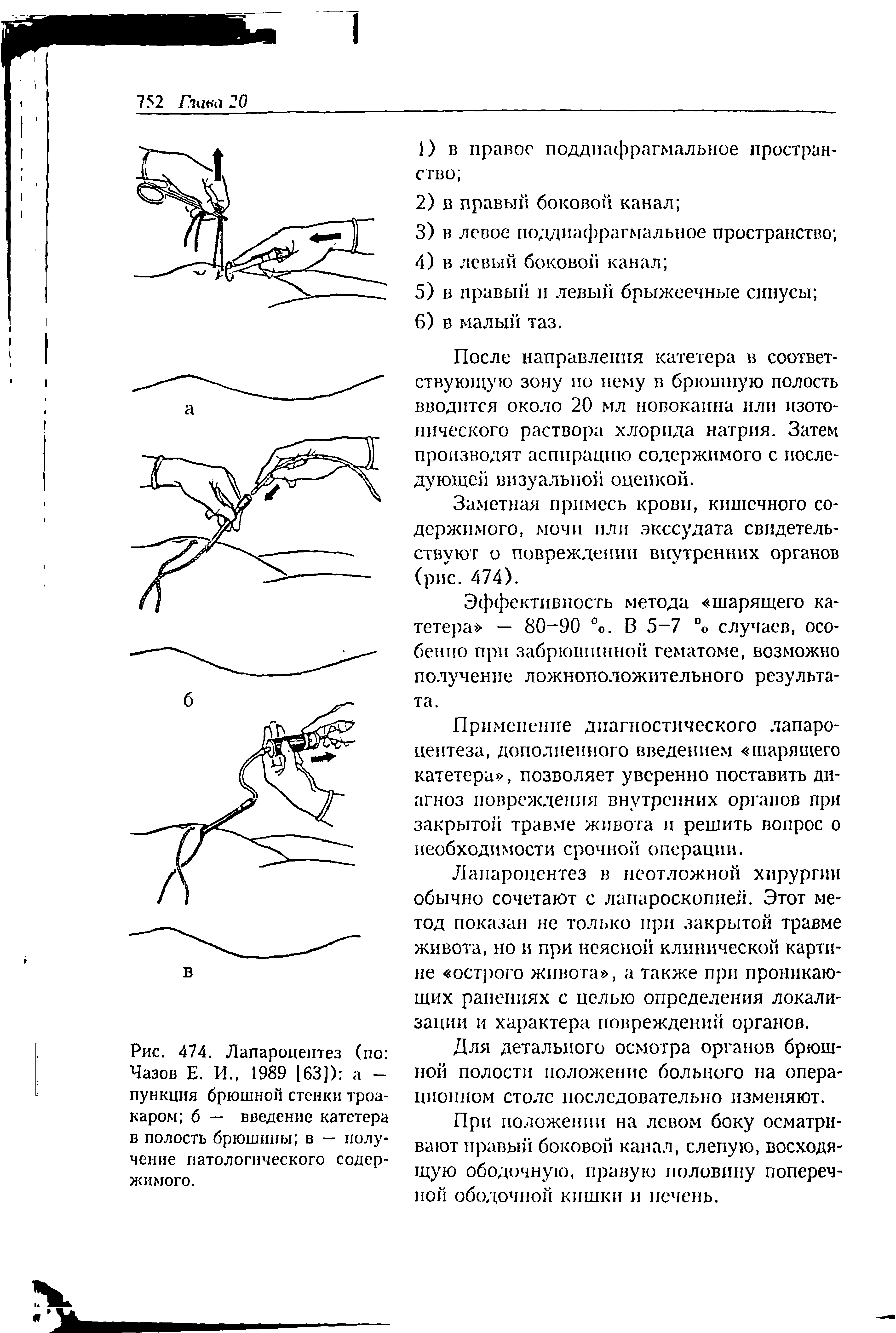 Рис. 474. Лапароцентез (по Чазов Е. И., 1989 [63]) а -пункция брюшной стенки троакаром б — введение катетера в полость брюшины в — получение патологического содержимого.