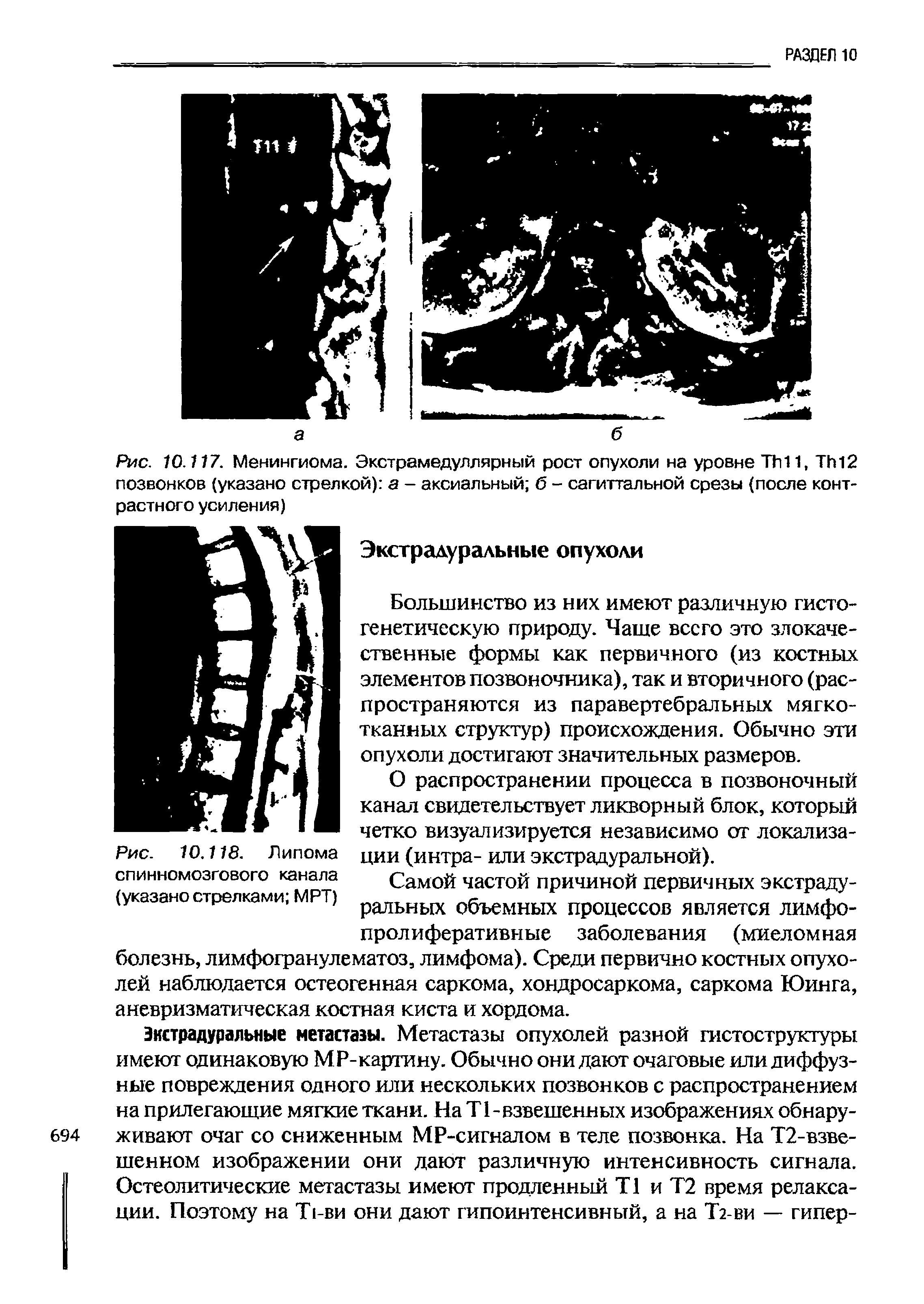 Рис. 10.117. Менингиома. Экстрамедуллярный рост опухоли на уровне ТИП, ТГг12 позвонков (указано стрелкой) а - аксиальный б - сагиттальной срезы (после контрастного усиления)...