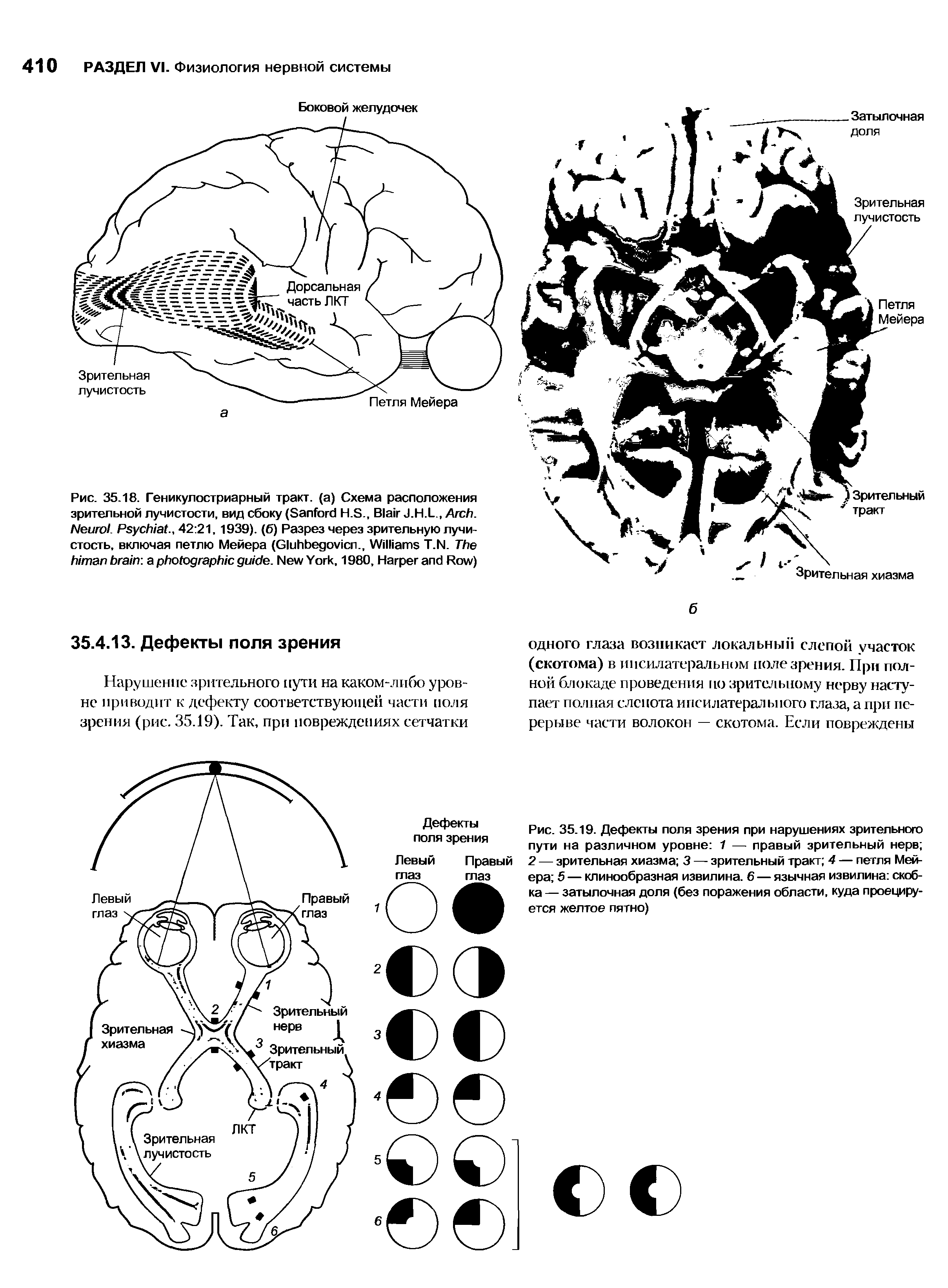 Рис. 35.19. Дефекты поля зрения при нарушениях зрительного пути на различном уровне 1 — правый зрительный нерв 2 — зрительная хиазма 3 — зрительный тракт 4 — петля Мейера 5 — клинообразная извилина. 6 — язычная извилина скобка — затылочная доля (без поражения области, куда проецируется желтое пятно)...