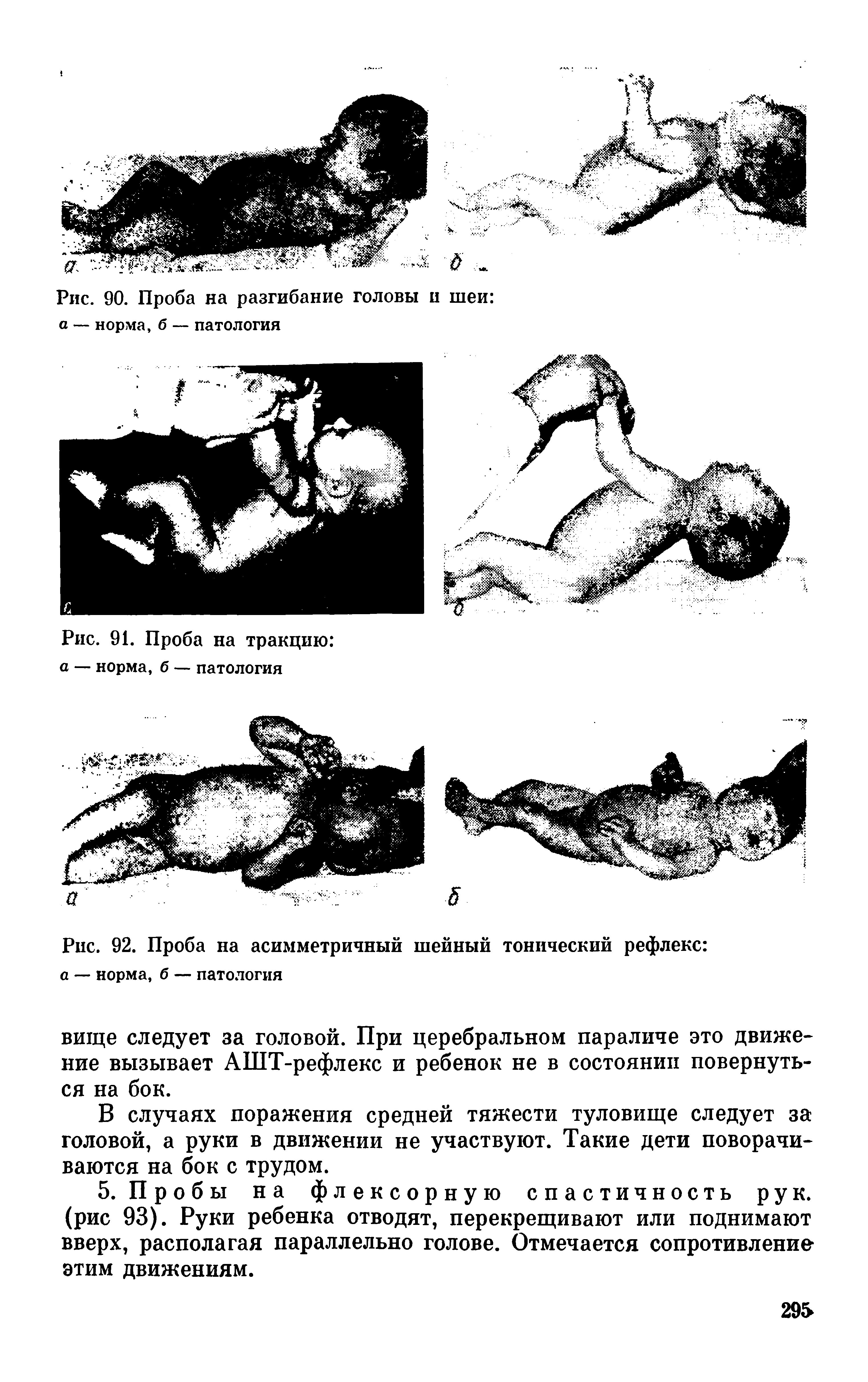 Рис. 92. Проба на асимметричный шейный тонический рефлекс а — норма, б — патология...