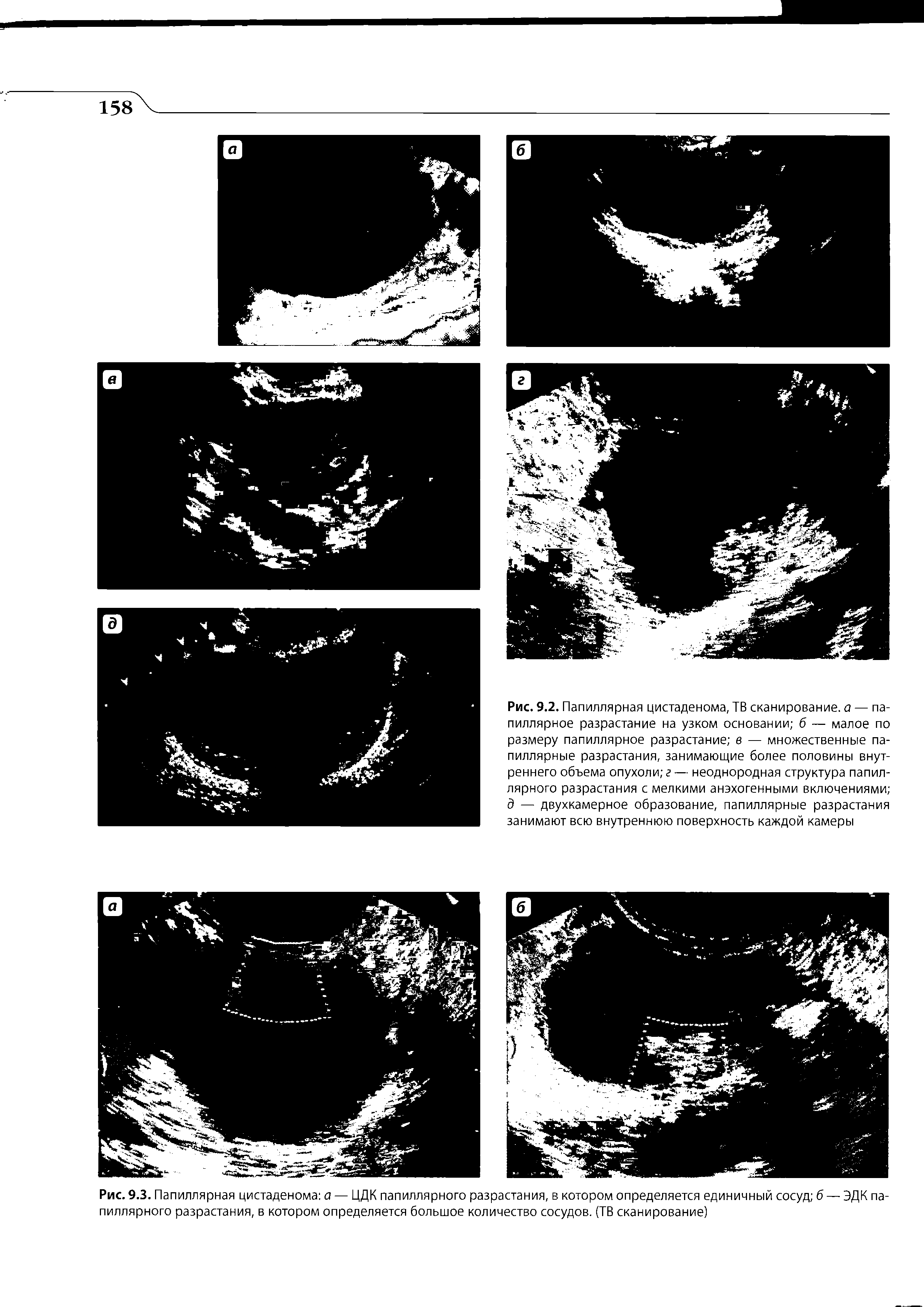 Рис. 9.3. Папиллярная цистаденома а — ЦДК папиллярного разрастания, в котором определяется единичный сосуд б — ЭДК папиллярного разрастания, в котором определяется большое количество сосудов. (ТВ сканирование)...