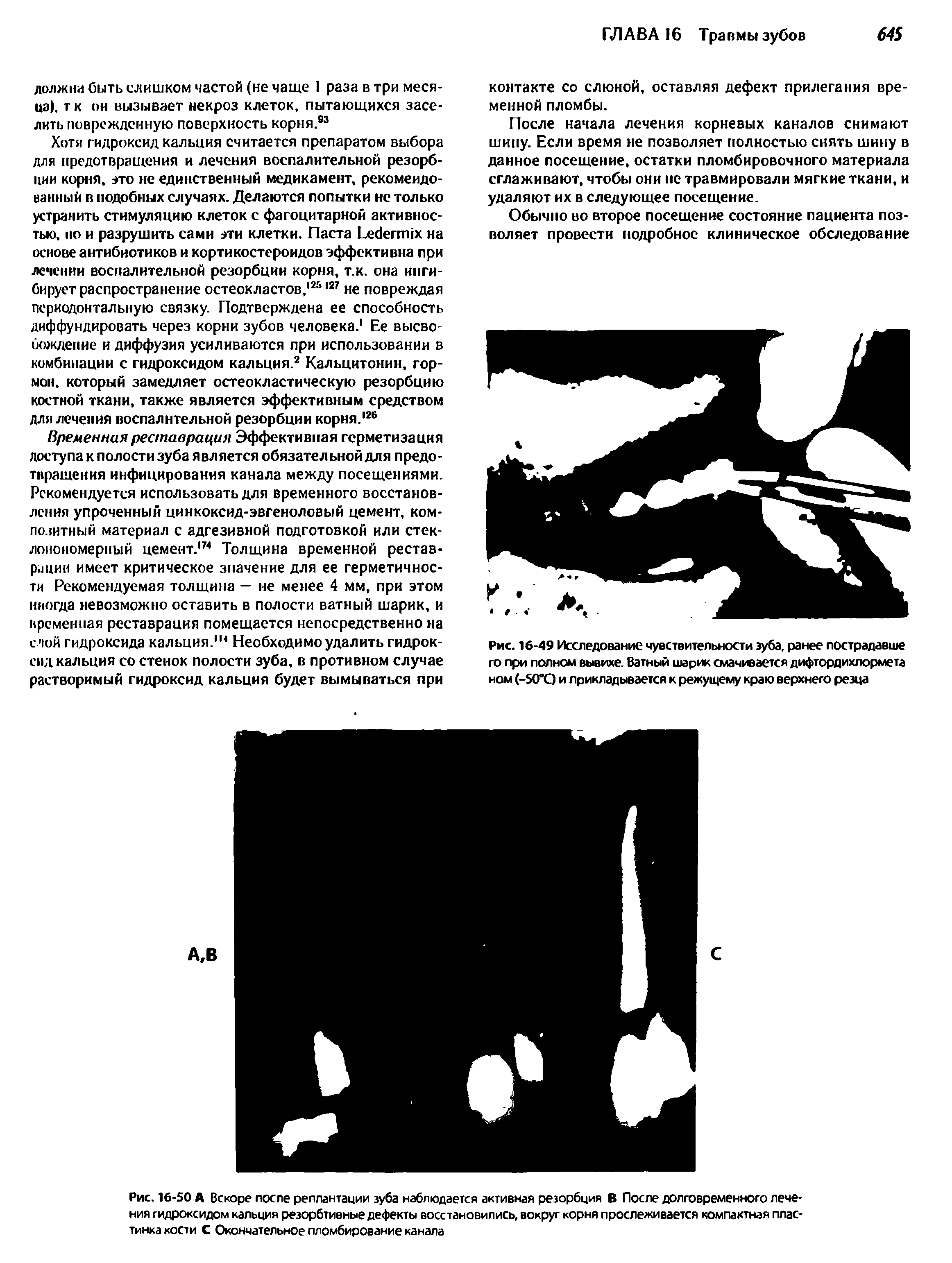 Рис. 16-50 А Вскоре после реплантации зуба наблюдается активная резорбция В После долговременного лечения гидроксидом кальция резорбтивные дефекты восстановились, вокруг корня прослеживается компактная пластинка кости С Окончательное пломбирование канала...
