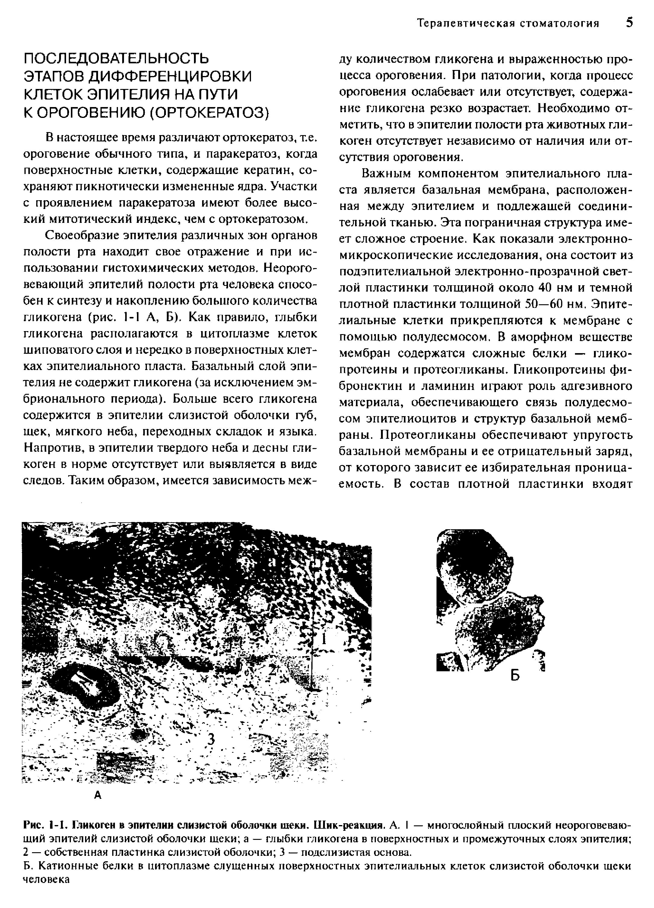 Рис. 1-1. Гликоген в эпителии слизистой оболочки теки. Шик-реакция. А. I — многослойный плоский неороговеваю-щий эпителий слизистой оболочки щеки а — глыбки гликогена в поверхностных и промежуточных слоях эпителия 2 — собственная пластинка слизистой оболочки 3 — подслизистая основа.