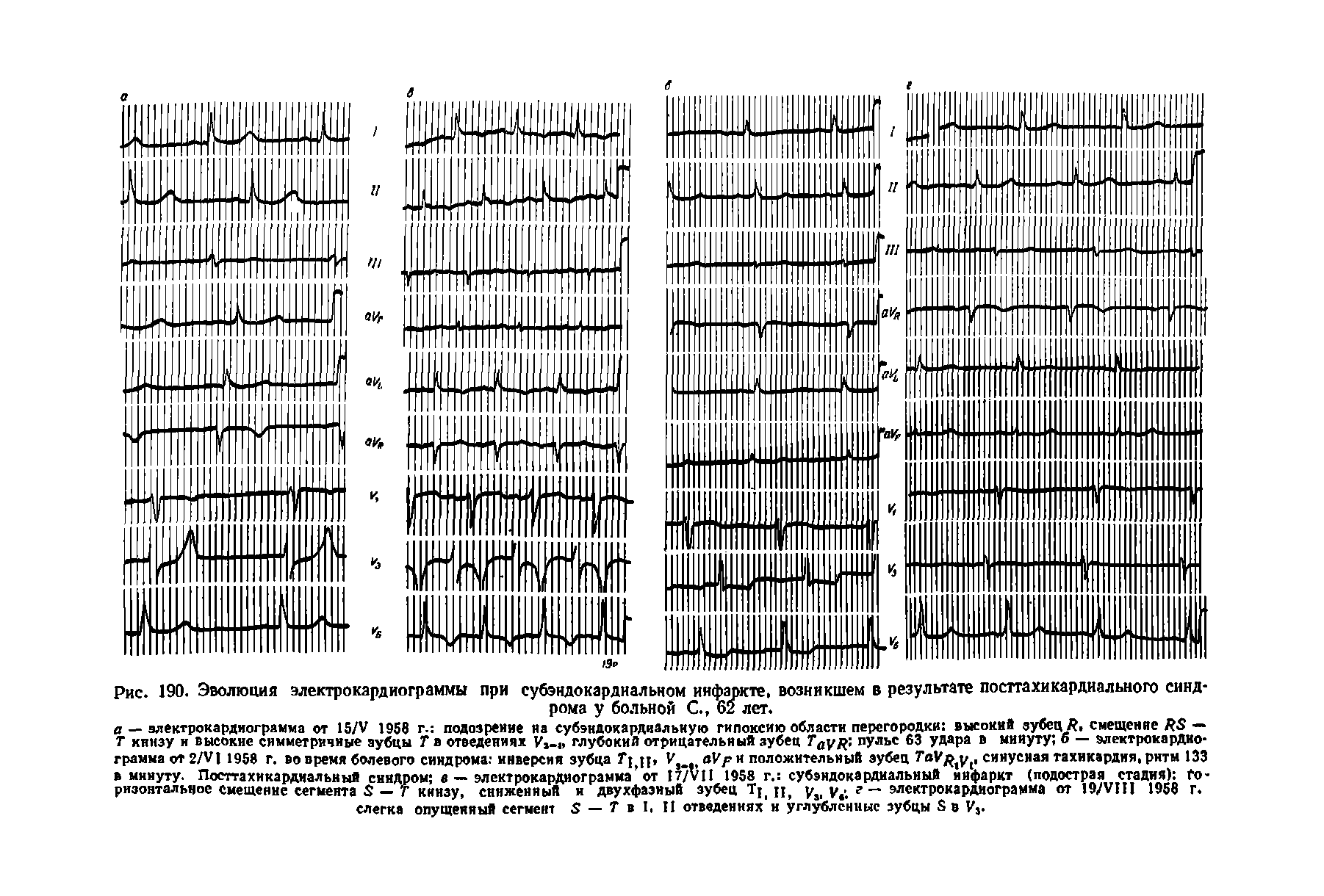 Рис. 190. Эволюция электрокардиограммы при субэндокардиальном инфаркте, возникшем в результате посттахикардиального синдрома у больной С., 62 лет.